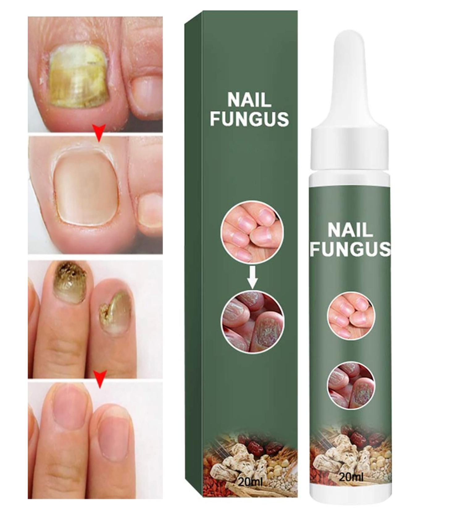 Healthy Nail Formula - Toenail Fungus Treatment & Repair Solution for Cracked, Discolored Nails - Buy Online on GoSupps.com