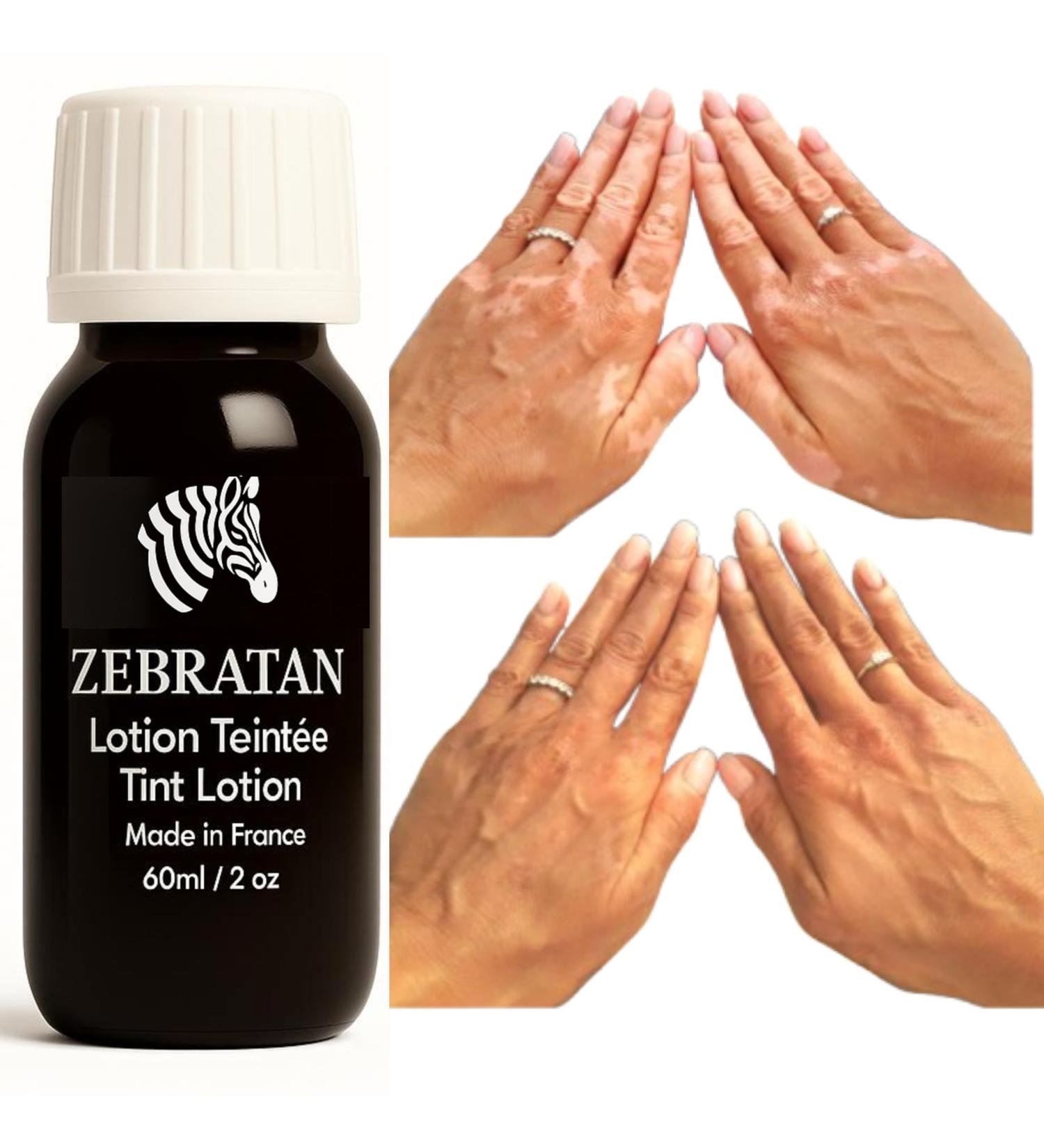  Zebratan Vitiligo Makeup Lotion 60 ml Mask White Spots on Skin Natural Camouflage Non Greasy No Foundation Men Women & Children Self Tanning Vegan Beige Brown - Buy Online on GoSupps.com
