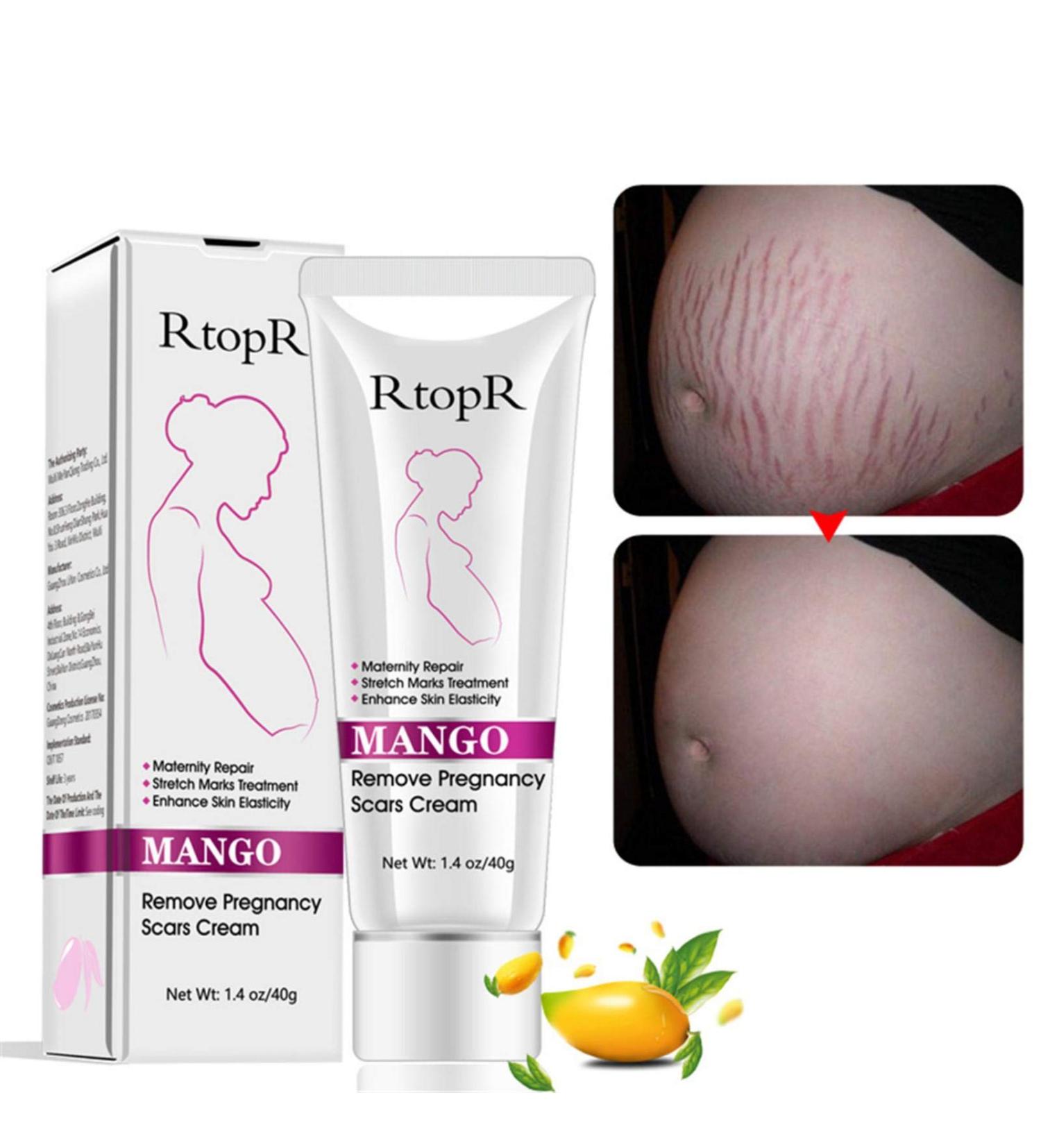 40G Remove Pregnancy Scars Scars and Acne Treatments for Pregnancy - Buy Online on GoSupps.com