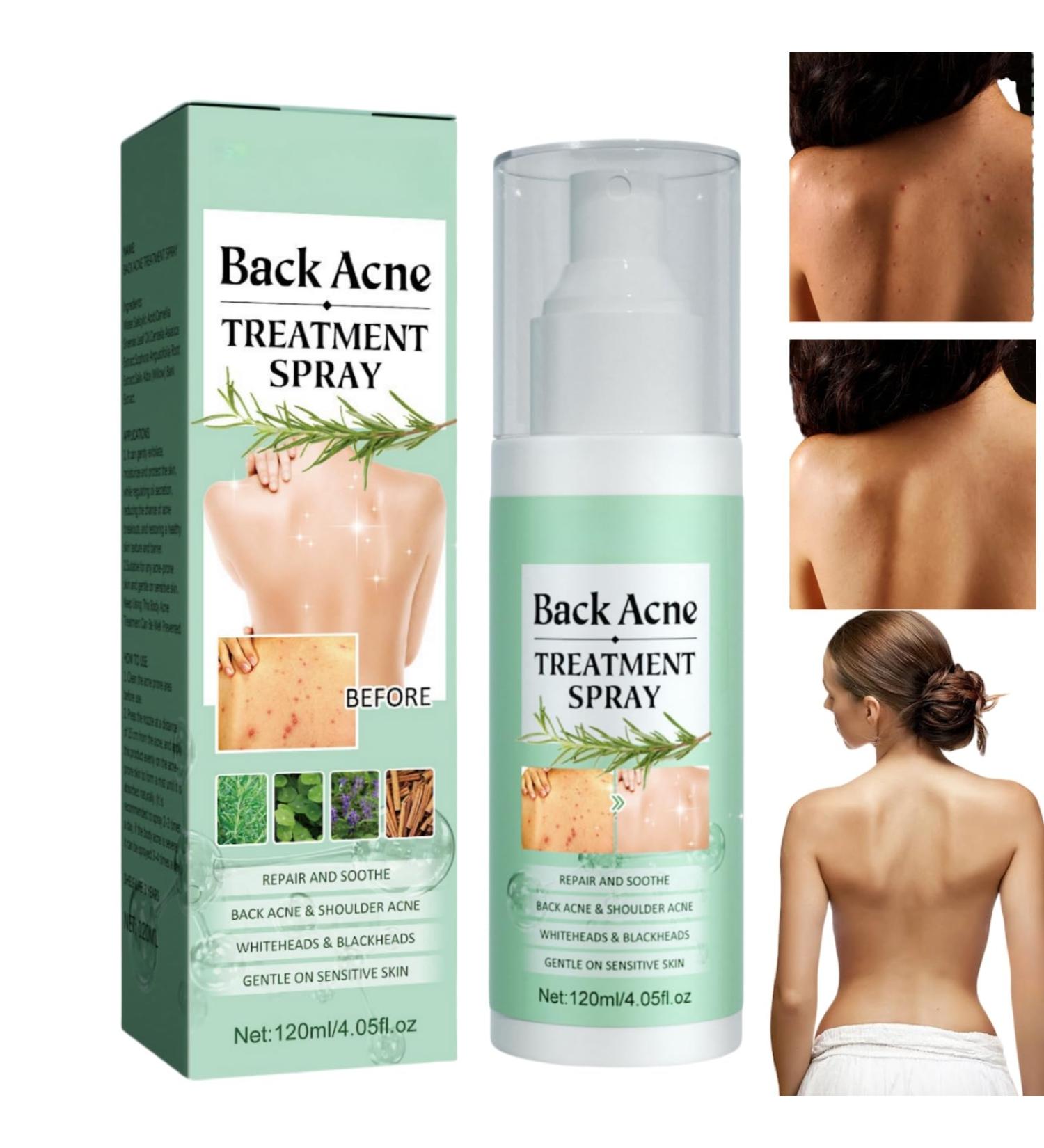 Back Acne Treatment Spray Acne Treatment Spray Acne Moisturiser for Back Body Body Acne Treatment Acne Back Treatment Back Spray Acne Body Acne Spray Back Acne Treatment Acne Body Spray 120ml - Buy Online on GoSupps.com