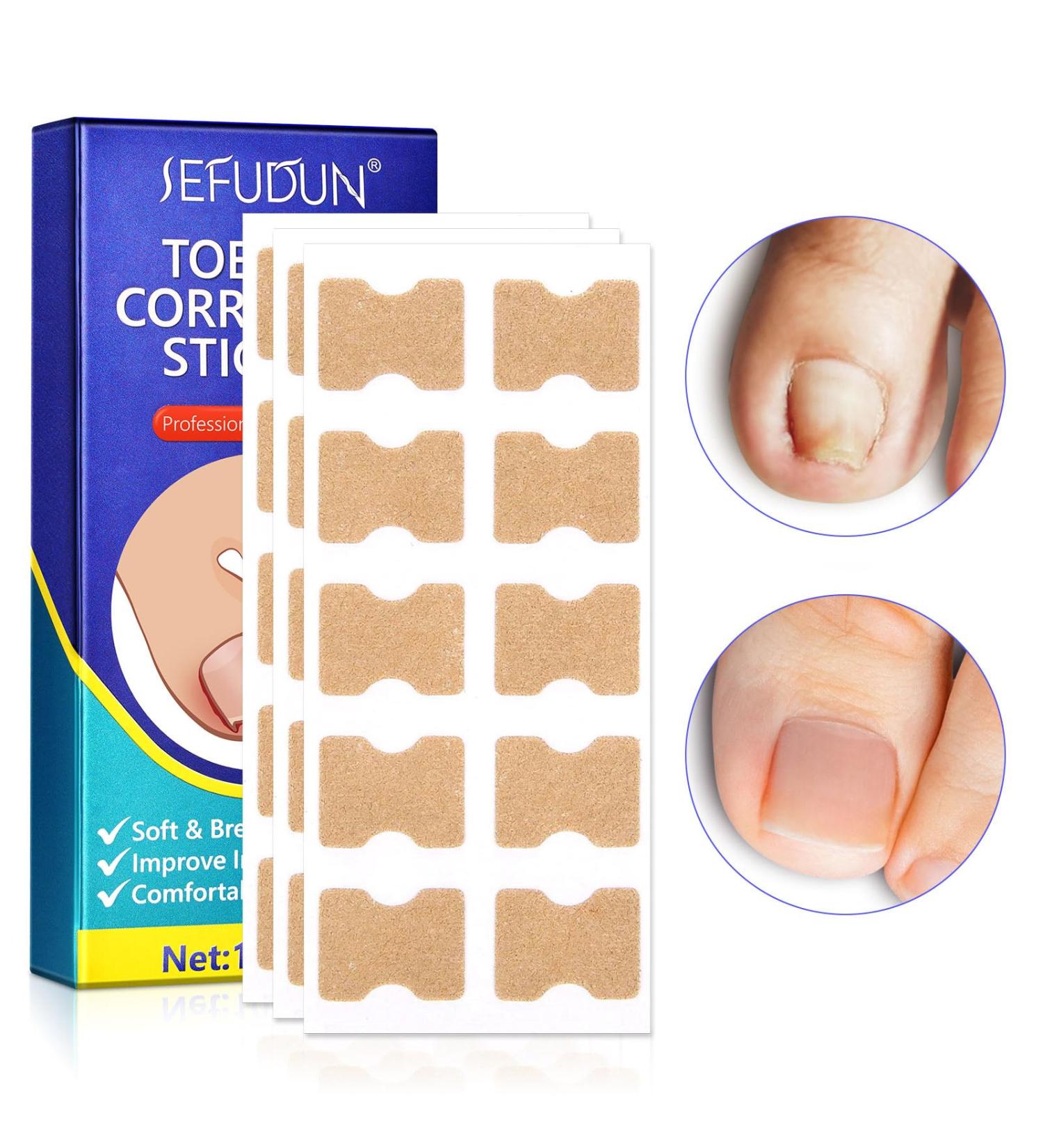 Ingrown Toenail Treatment - Painless Corrector Strips & Nail Correction Patches | 100 Pcs - Buy Online on GoSupps.com