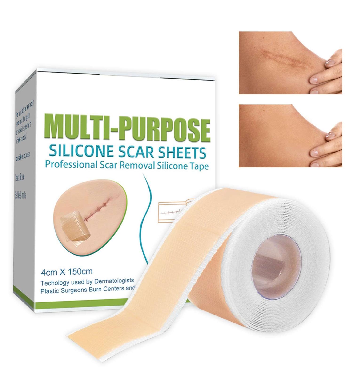 Medical Grade Silicone Scar Sheets - 1.6 x 60 inches - C-Section, Keloids, Tummy Tuck - Reduce Scarring and Promote Healing - Buy Online on GoSupps.com