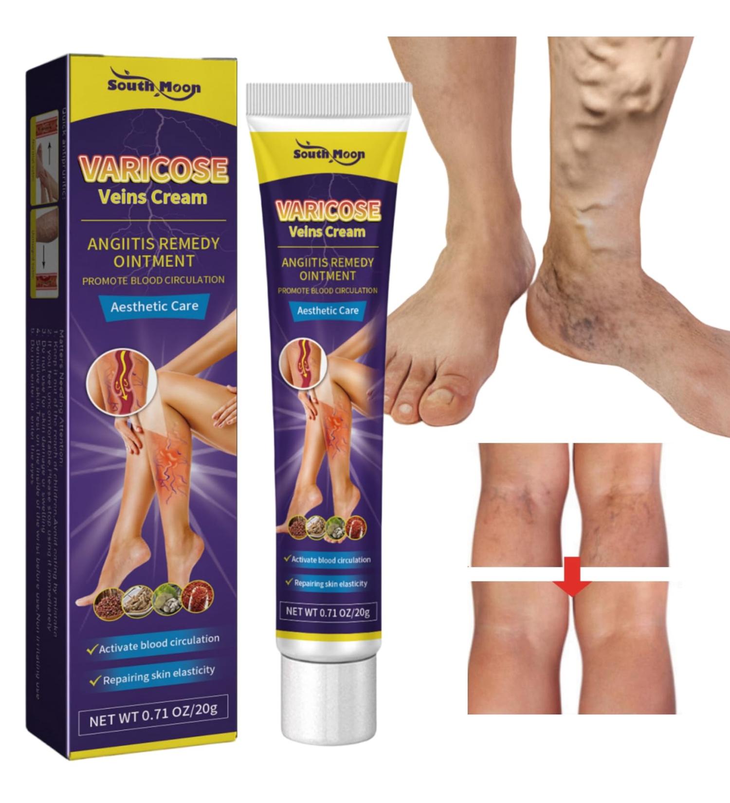 Varicose Veins Cream Spider Vein Cream Varicose Veins Treatment for Legs Spider Veins Treatment Cream Vein Cream for Legs Spider Veins Repair Cream Varicose Veins Ointment Aching Legs Relief - Buy Online on GoSupps.com