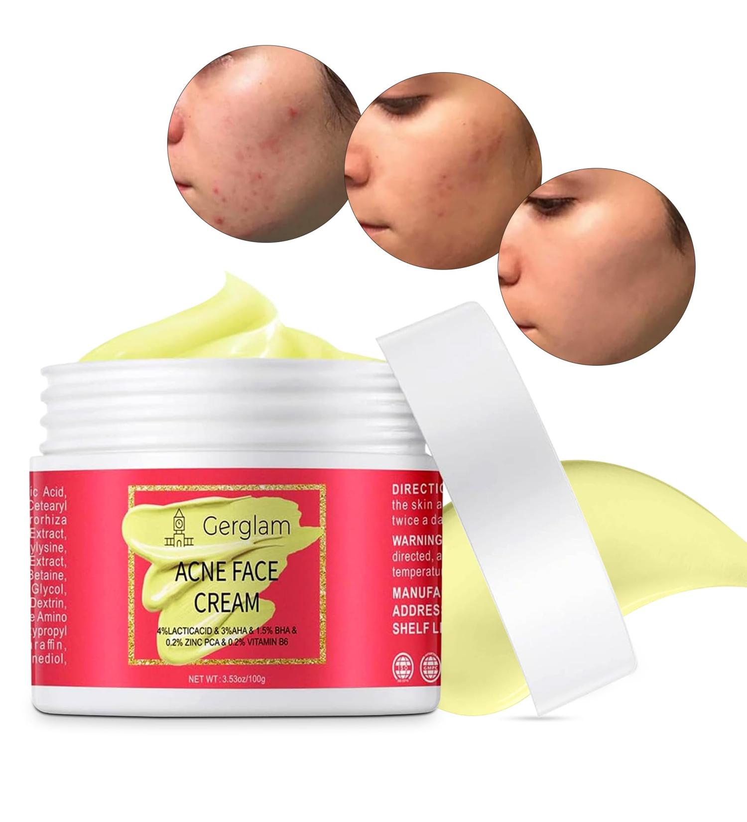 Acne Face Cream with Salicylic Acid | Cystic Acne Treatment for Face & Body | Anti-Acne Skincare for Teens & Adults | 3.53 OZ - Buy Online on GoSupps.com