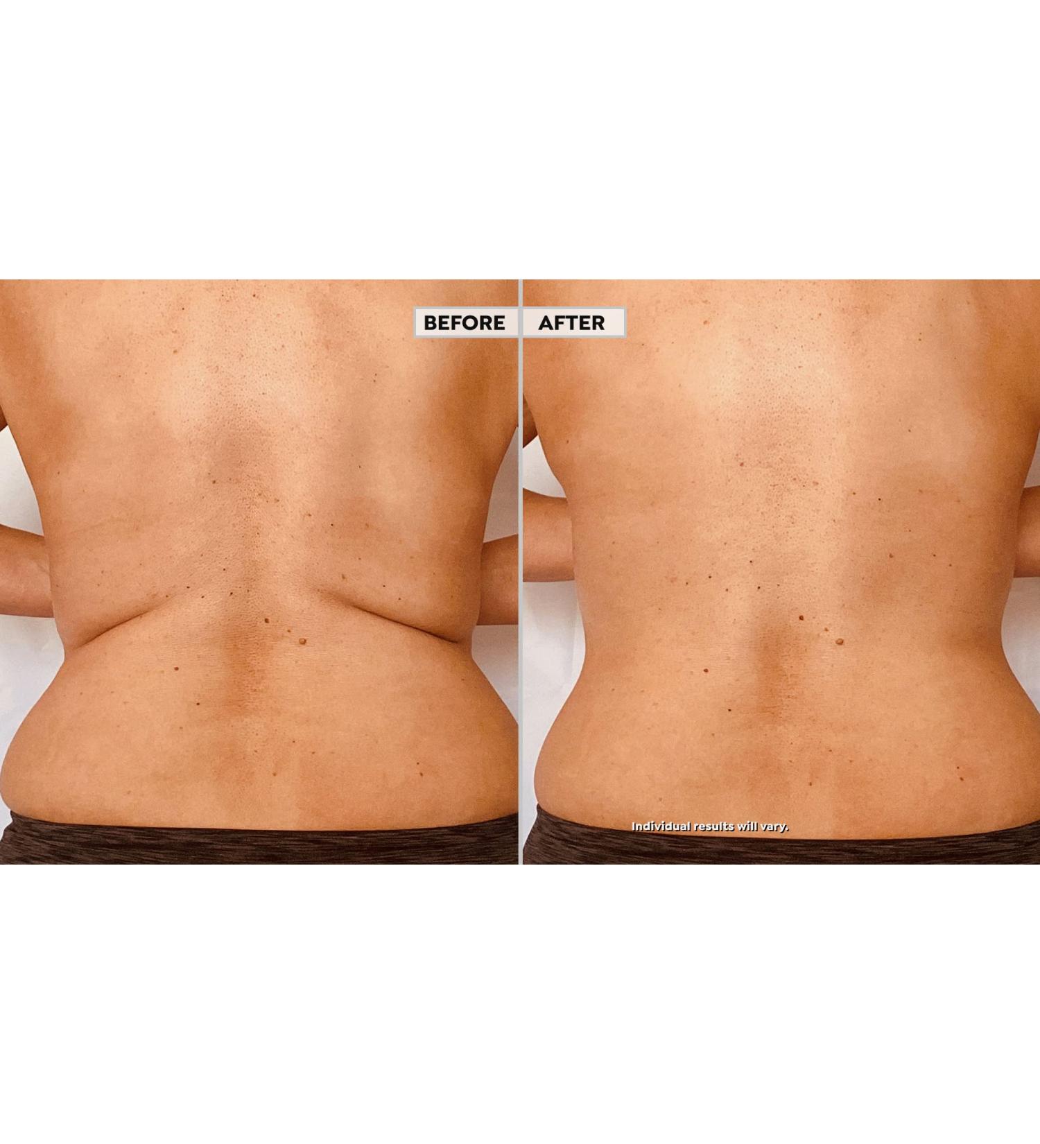 Skinnies Instant Lifts - 5 Pair Clear Adhesive Back Lifts | Patented, Made in USA | Instantly Smooth & Flatten Back Fat - Buy Online on GoSupps.com