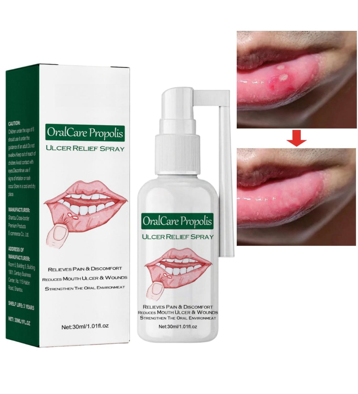 Mouth Ulcer Treatment Spray Mouth Ulcer Treatment for Adults Canker Sore Treatment Oral Care Spray Herbal Mouth Spray Canker Sores Relief Spray for Mouth Ulcer Bad Breath Treatment Mouth Freshener - Buy Online on GoSupps.com