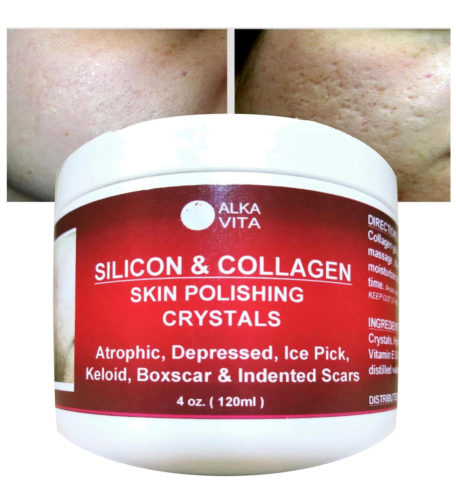 Clear Alka Vita Acne Scars Gel - Silicon & Collagen Crystals for Atrophic & Keloid Scars - 4.0 Fl Oz - Buy Online on GoSupps.com