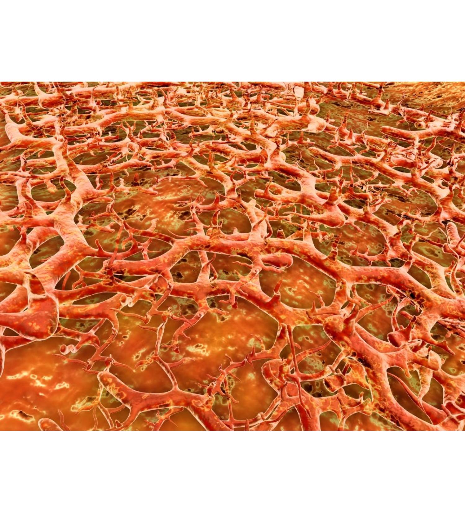 Posterazzi Close-up view also known as ringworm tinea pedis. Athlete's foot fungus is a fungal infection of the skin Poster Print (32 x 24)