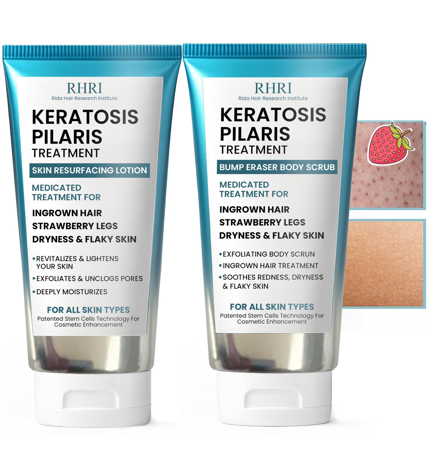 KP Bump Eraser Body Set with 10% AHA | Keratosis Pilaris Treatment | Keratosis Pilaris Lotion | Exfoliating Body Scrub | Ingrown Hair Treatment | Bundle Set for Bump, Strawberry Legs, Redness, Dryness KP Scrub + Lotion - Buy Online on GoSupps.com