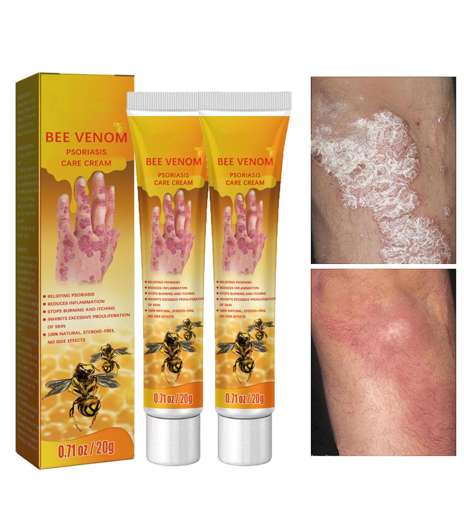 EasPowest Youth Bee New Zealand Professional Bee Venom Psoriasis Treatment Cream Soothing Moisturizing Psoriasis Cream (2PCS) - Buy Online on GoSupps.com