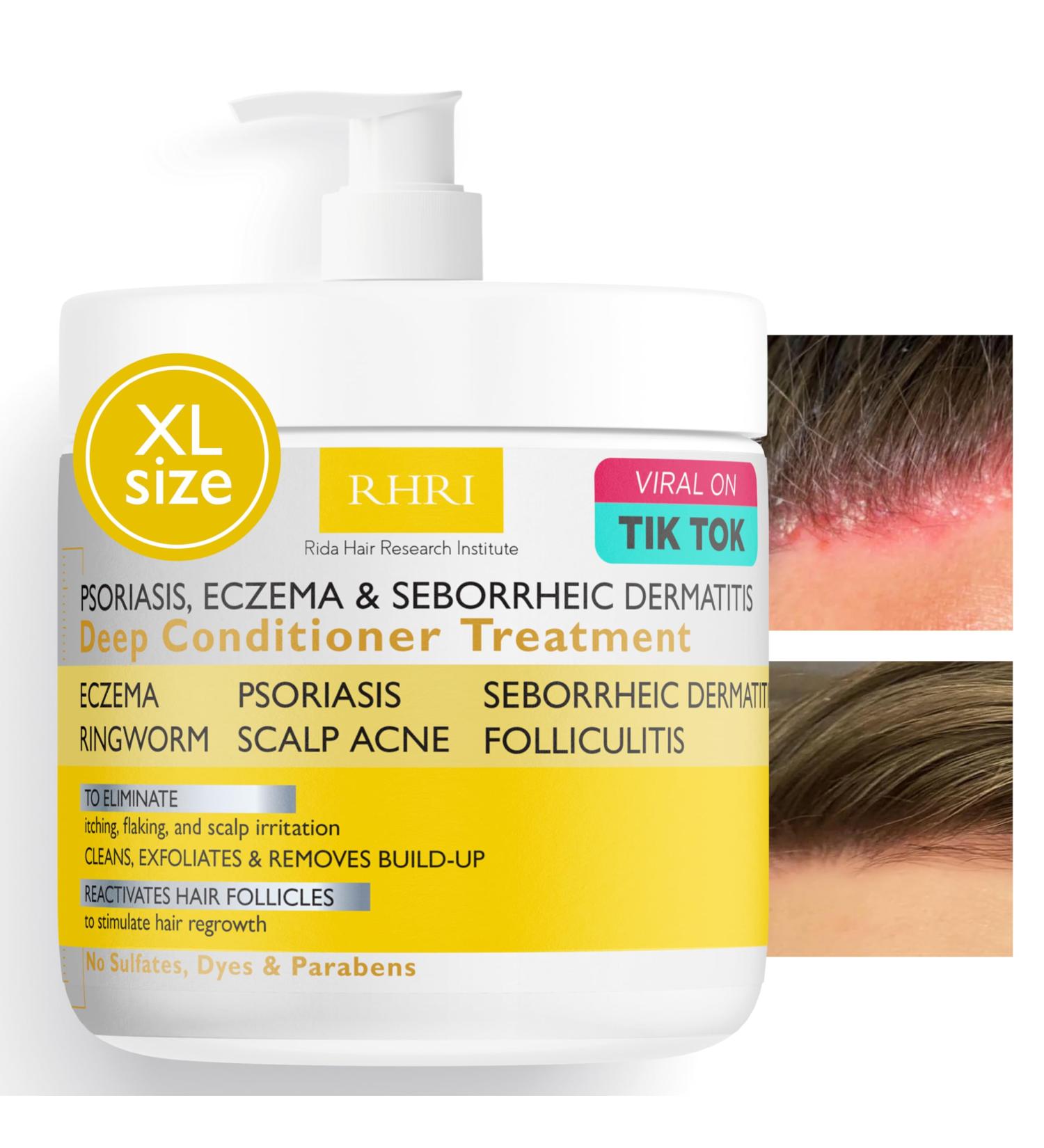 Antifungal Psoriasis Deep Conditioner Treatment for Eczema & Seborrheic Dermatitis | Soothes Itching Repairs Scalp Strengthens Hair & Stimulates Regrowth | Shop Internationally - Buy Online on GoSupps.com