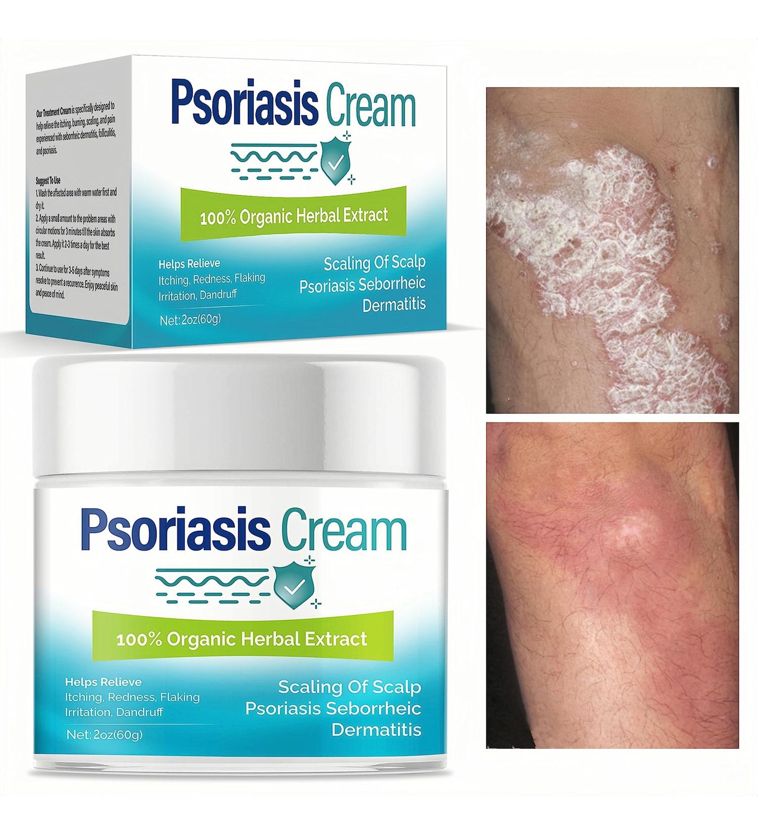 iTecFreely Psoriasis Cream: Fast & Effective Scalp Treatment for Dry Scalp, Dandruff & Eczema - Face and Body Relief - Buy Online on GoSupps.com