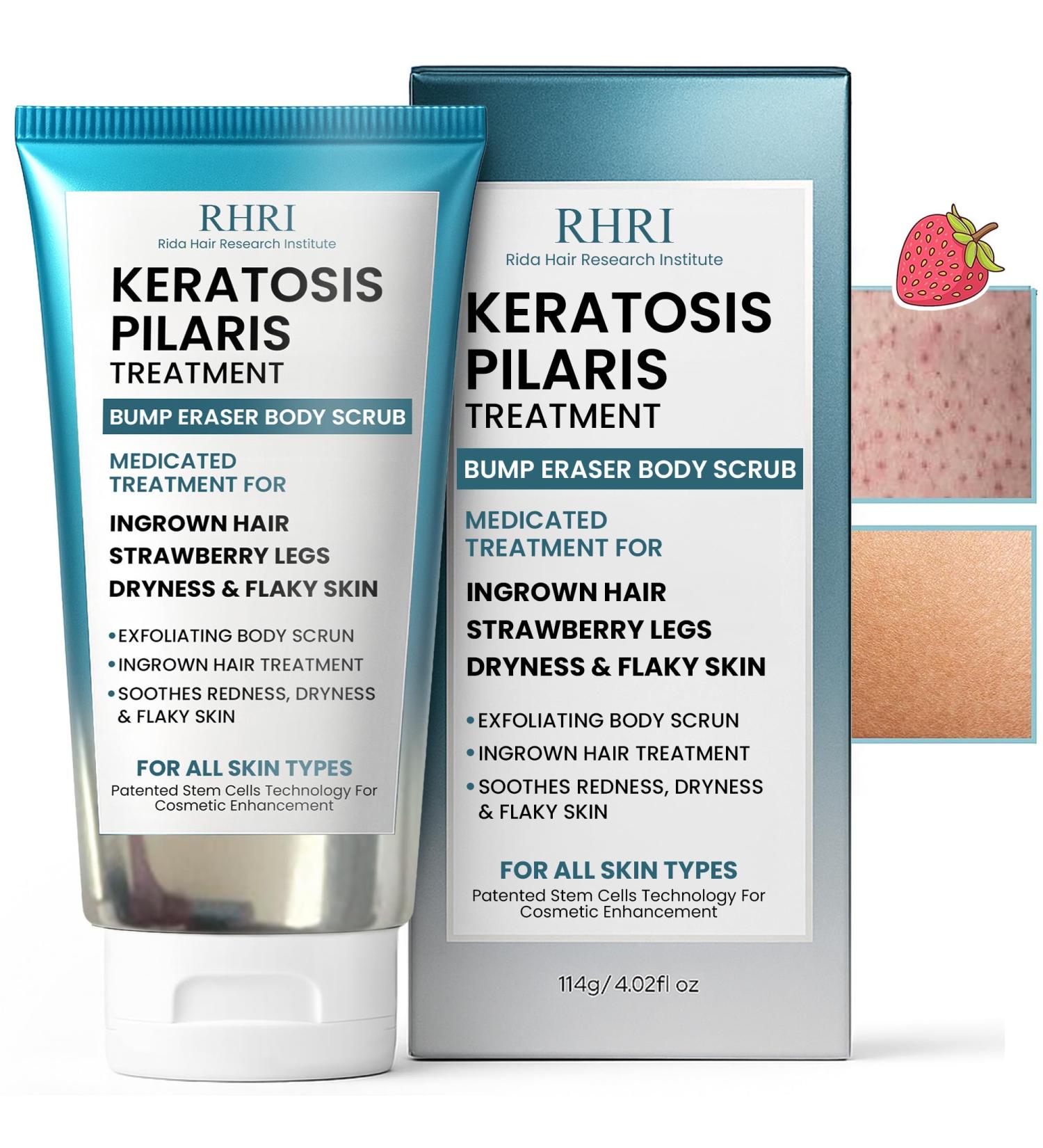KP Bump Eraser Body Scrub with 10% AHA | Keratosis Pilaris Treatment | Bump Eraser Body Scrub | Ingrown Hair Treatment | Clears Strawberry Legs | Soothes Redness, Dryness & Flaky Skin KP Scrub - Buy Online on GoSupps.com