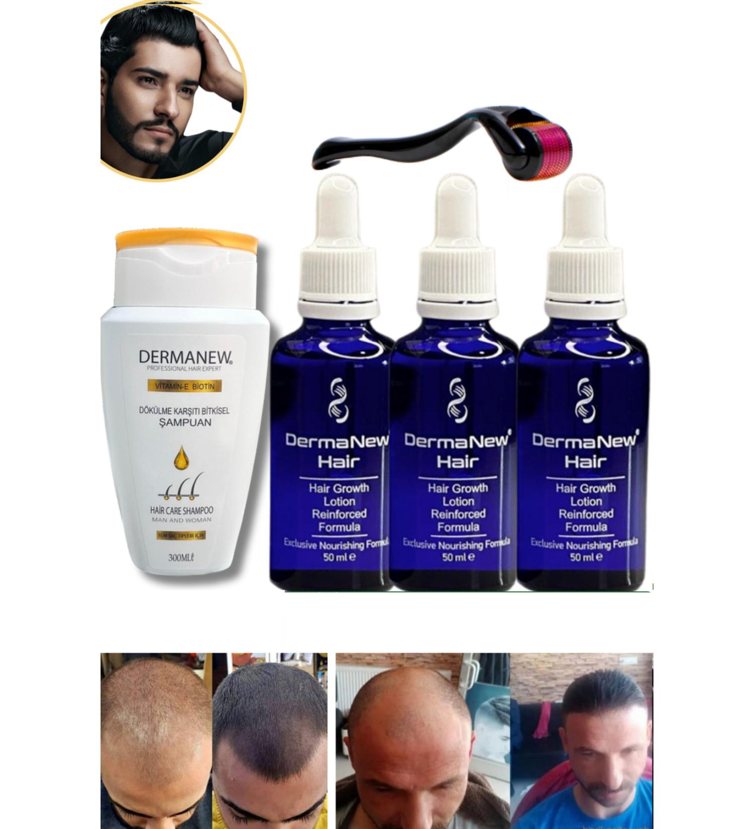 dermanew hair hair serum hair care oil3 Pieces Serum + Roller + Shampoo - Buy Online on GoSupps.com