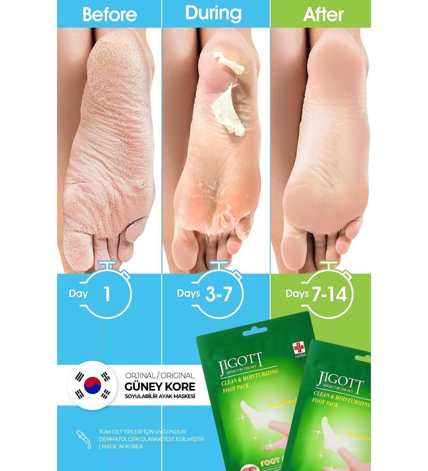 Jigott Sock Type Peeling Foot Mask - Miracle Foot Peeling Pack