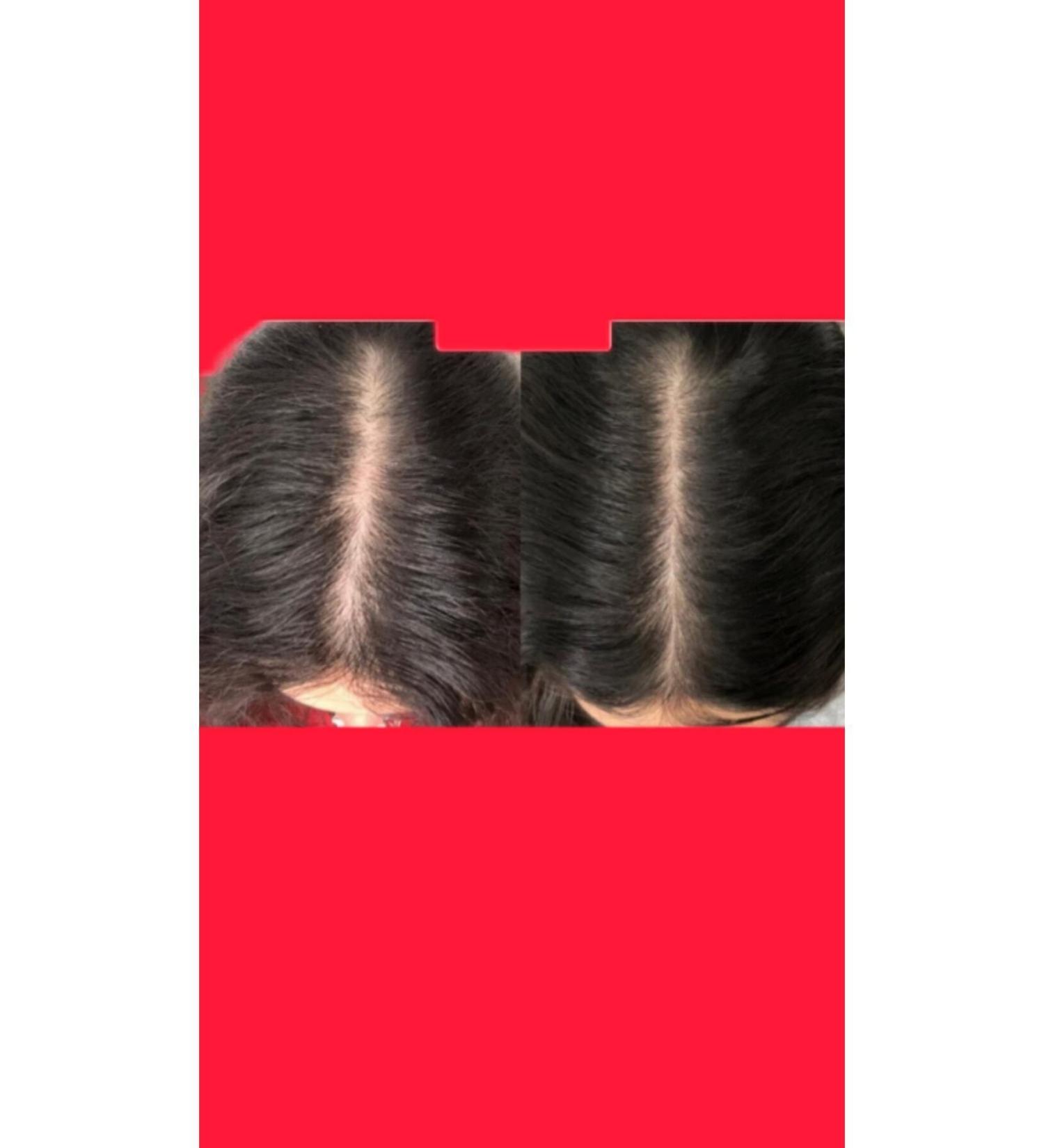 Borkaon Hairon Plus Blue Serum (1 Piece)