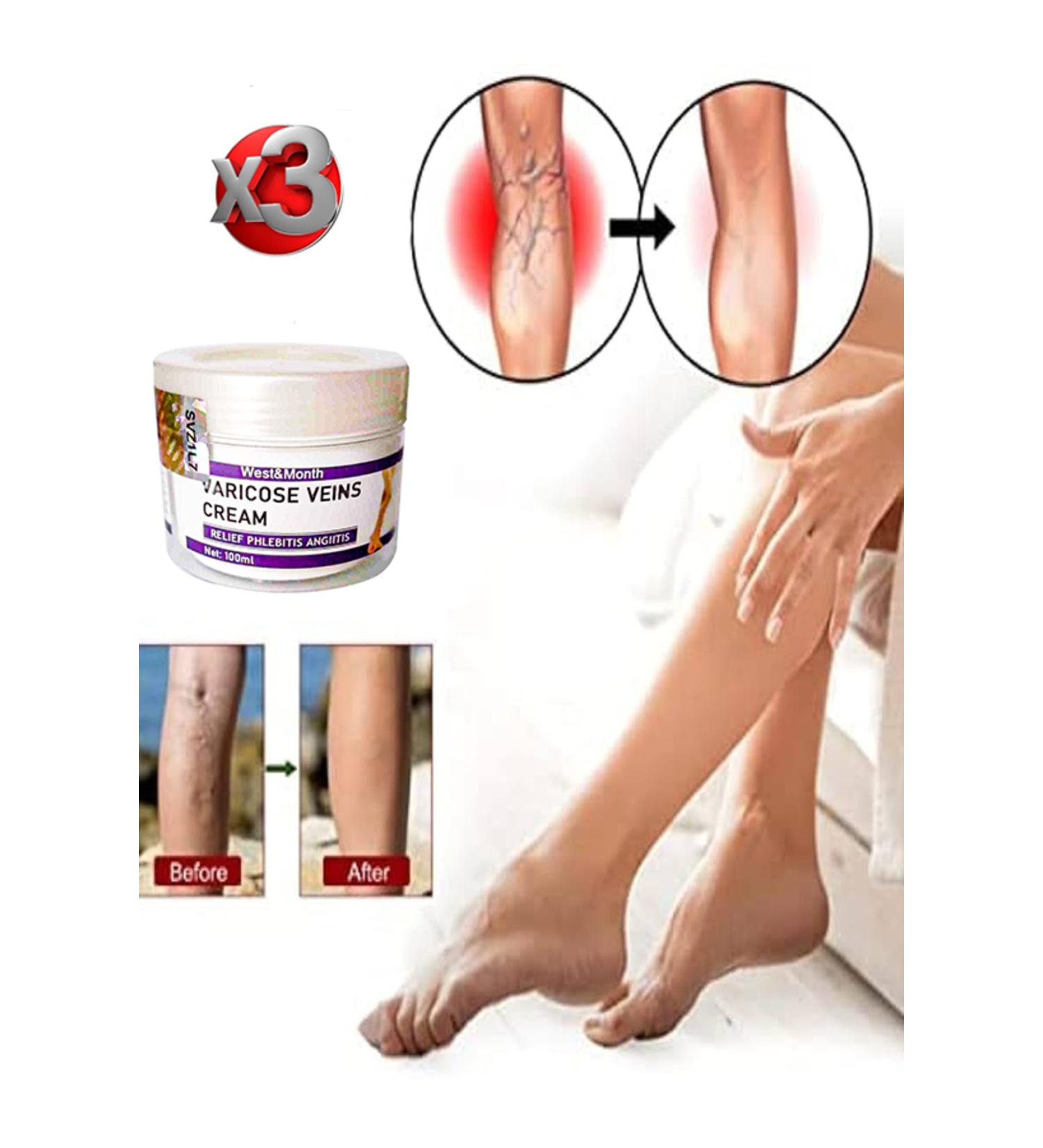 H NTOHU Varicose Veins Purple Cream Sililit and its opposite 100 ml x 3 pcs