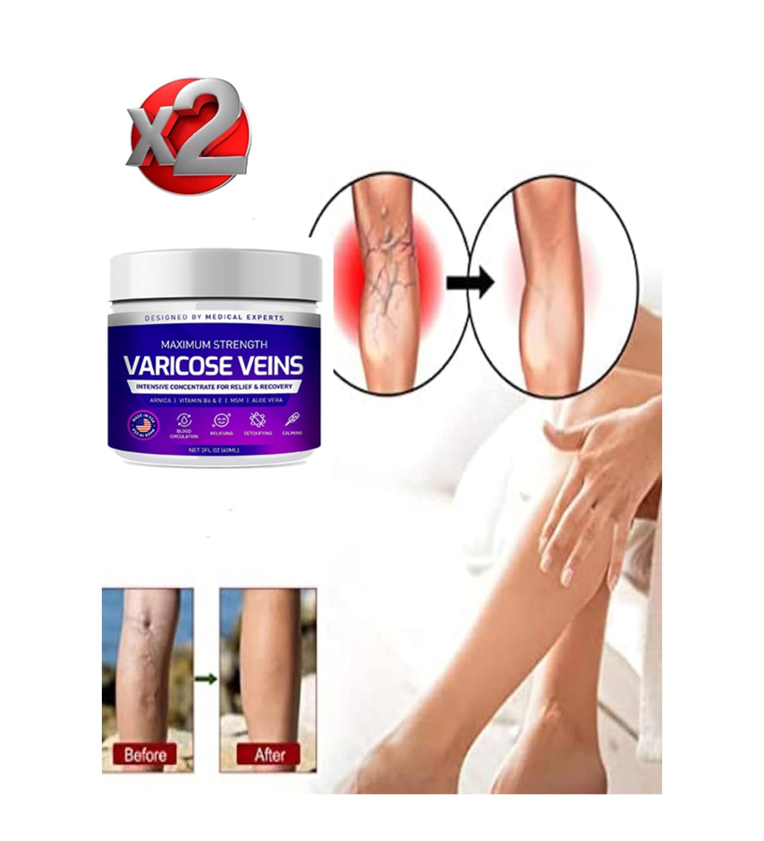 TAMNET Maximum Strength Varicose Veins Care Cream 100 ml x 2 pieces
