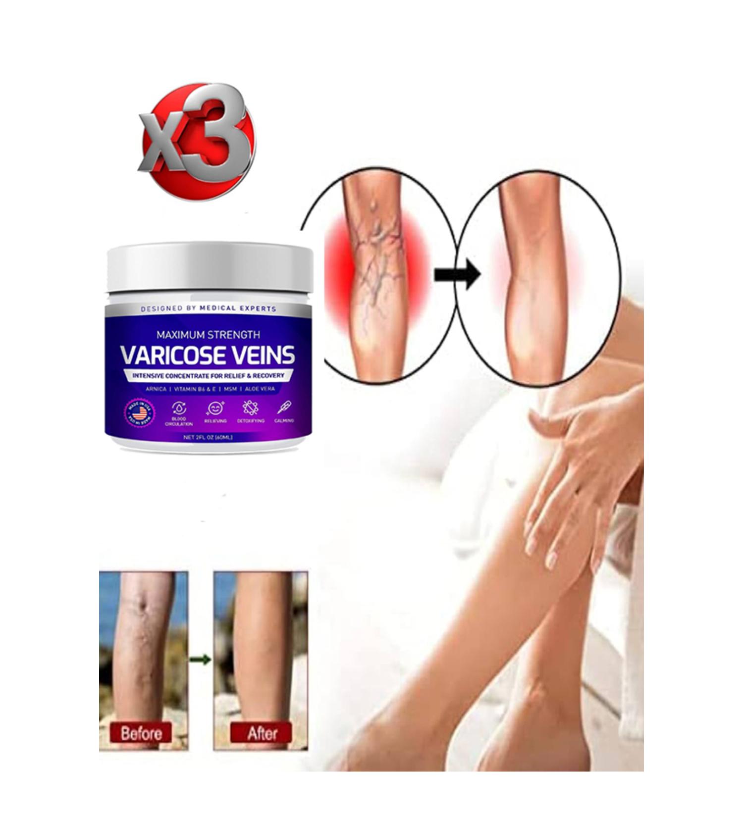 TAMNET Maximum Strength Varicose Veins Care Cream 100 ml x 3 pieces