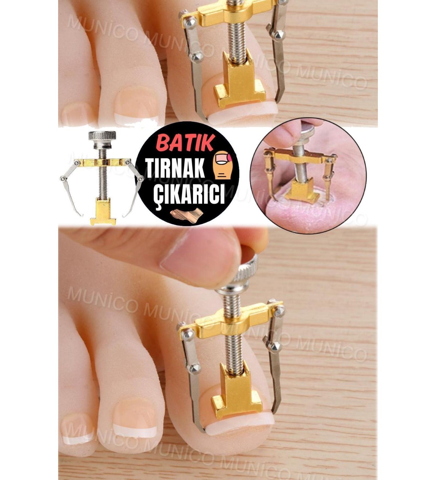 The End of Ingrown Nails at Home - Adjustable and Unbreakable Steel Tool