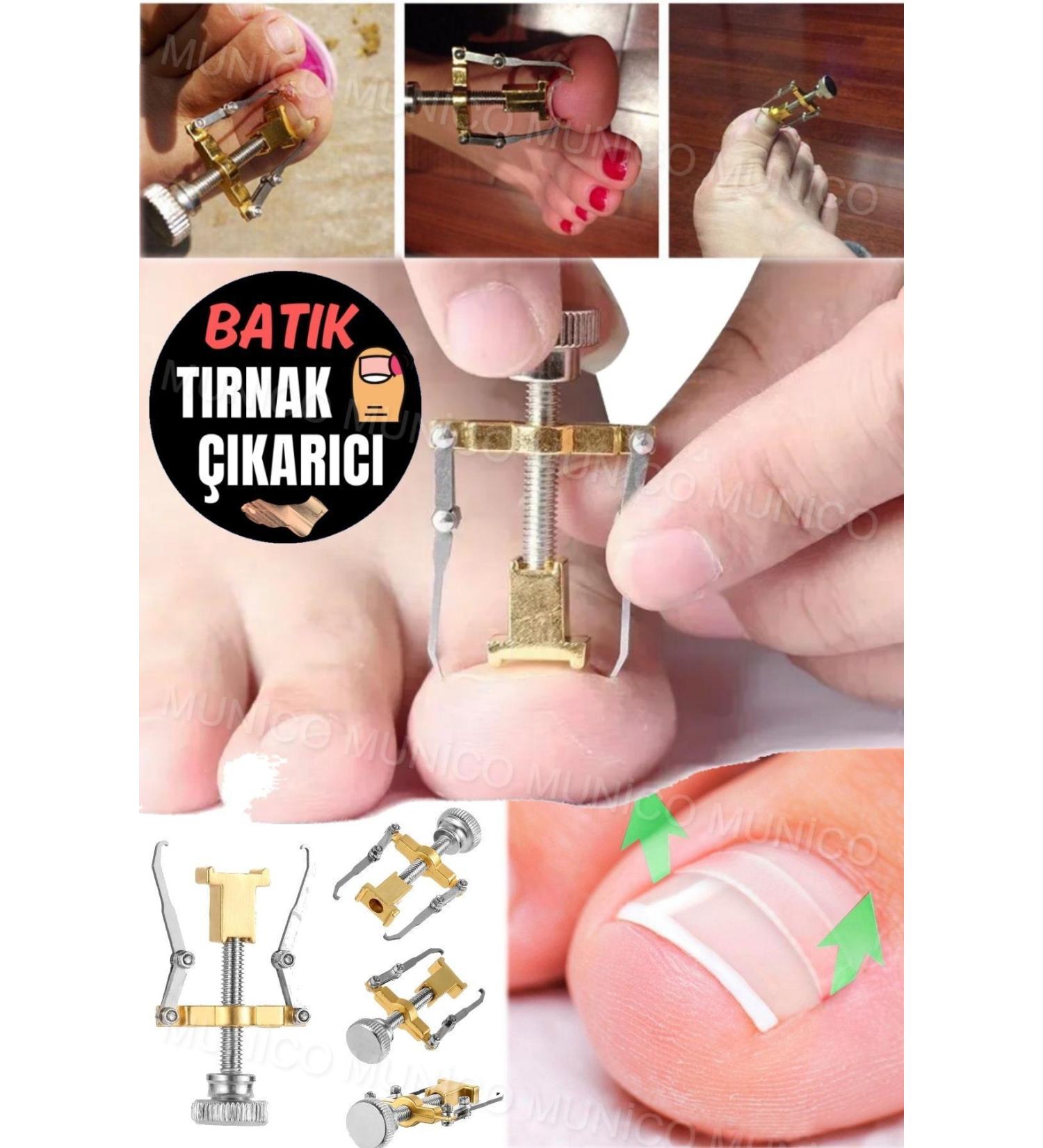 Ingrown Nail Removal Professional Tool You Can Use At Home Easy To Use Ingrown Nail Removal