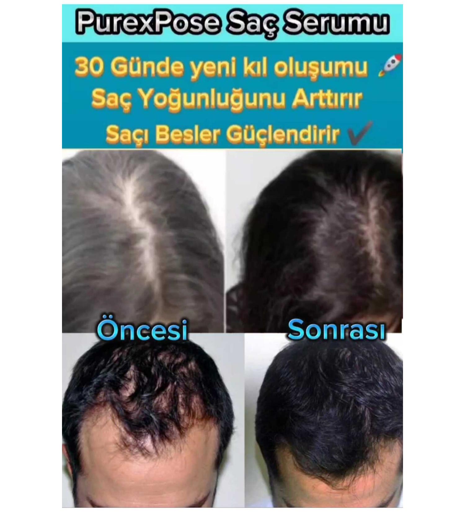 Purexpose Hair and Thickening Serum Lotion 1 Piece - Buy Online on GoSupps.com