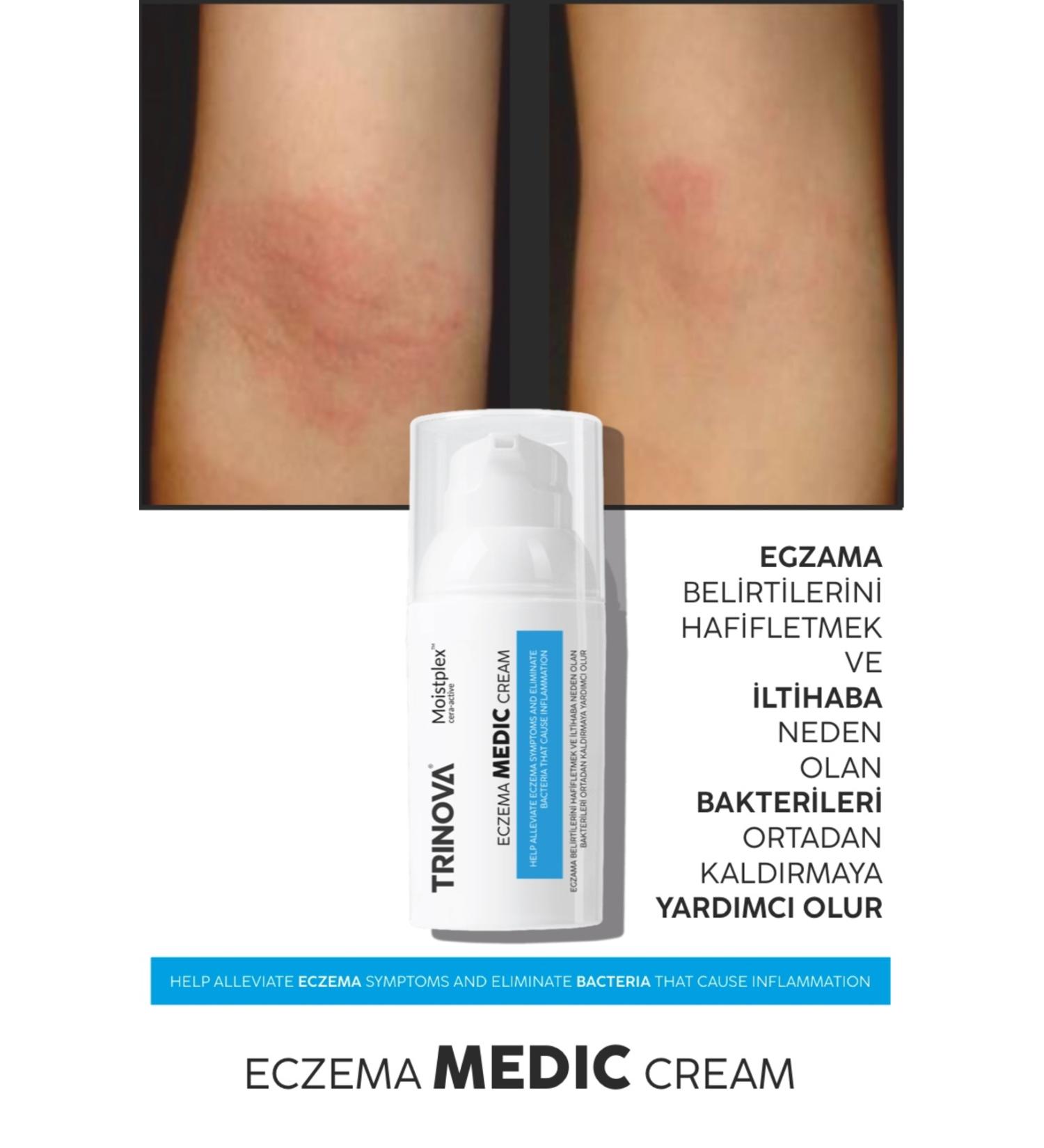 Trinova Eczema cream