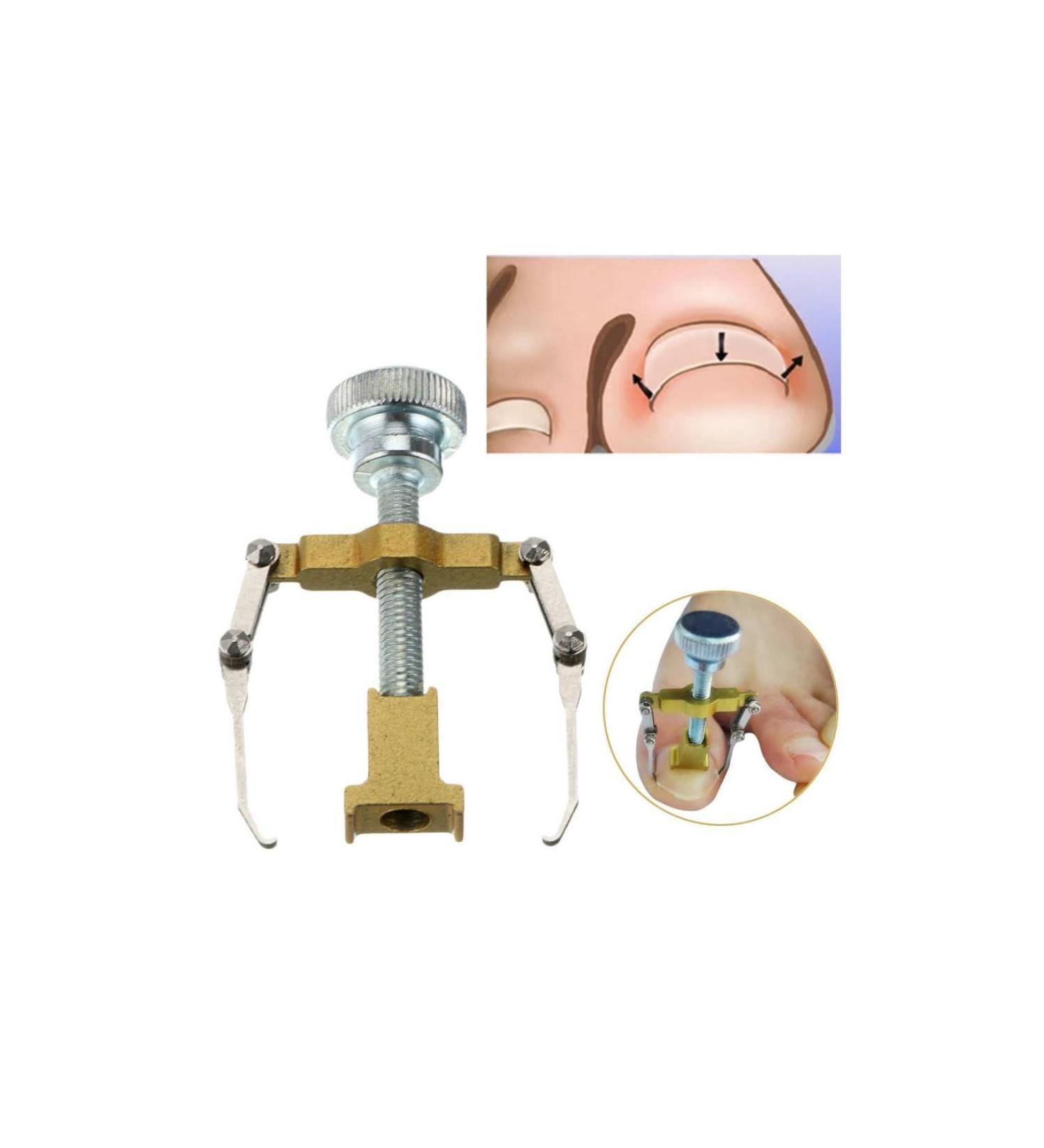 Professional Ingrown Toenail Correction Device