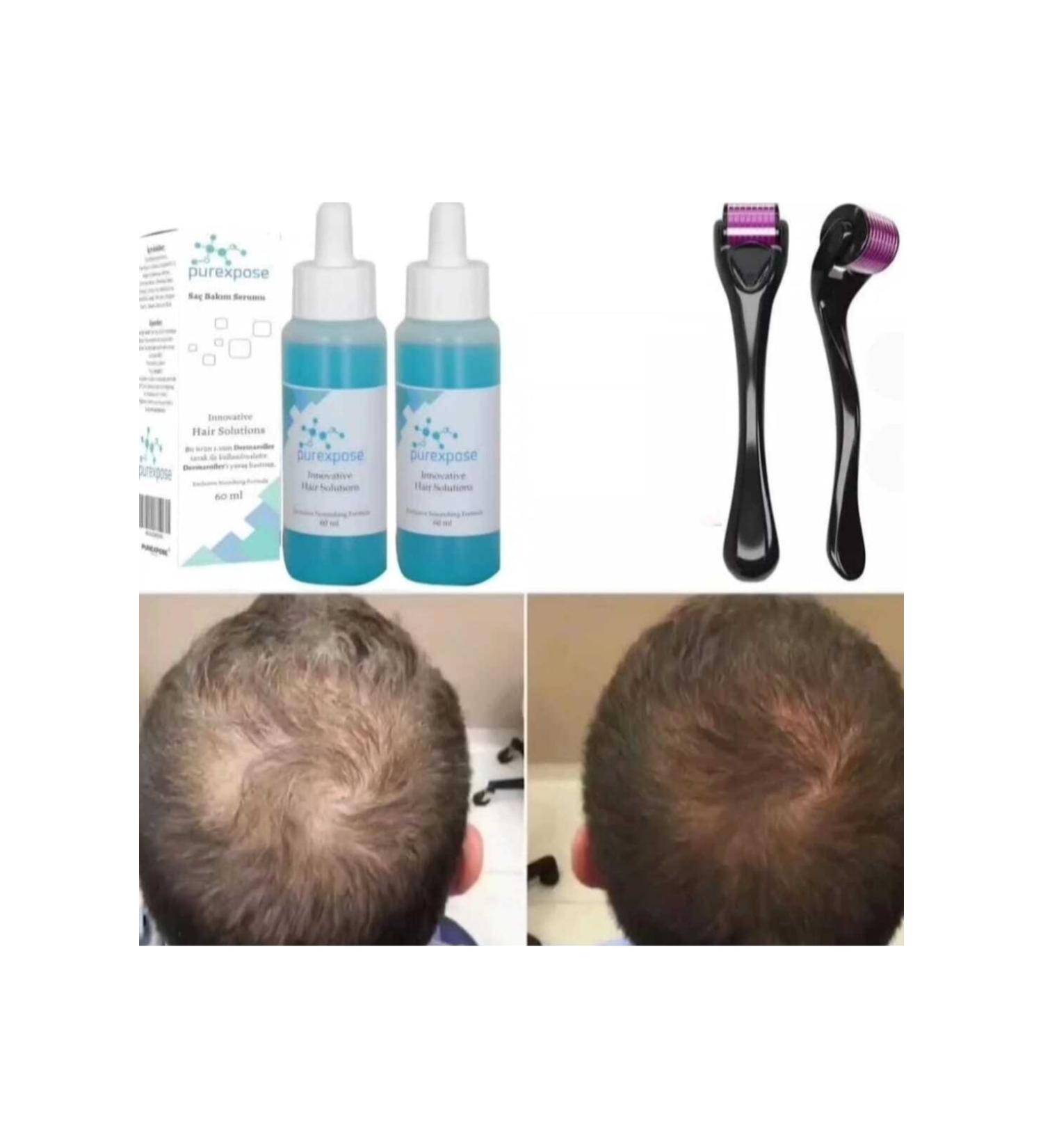 Purexpose Hair Care Serum Hair Nourishing Hair Growth Aid Serum - 2 Serum 1 Dermaroller