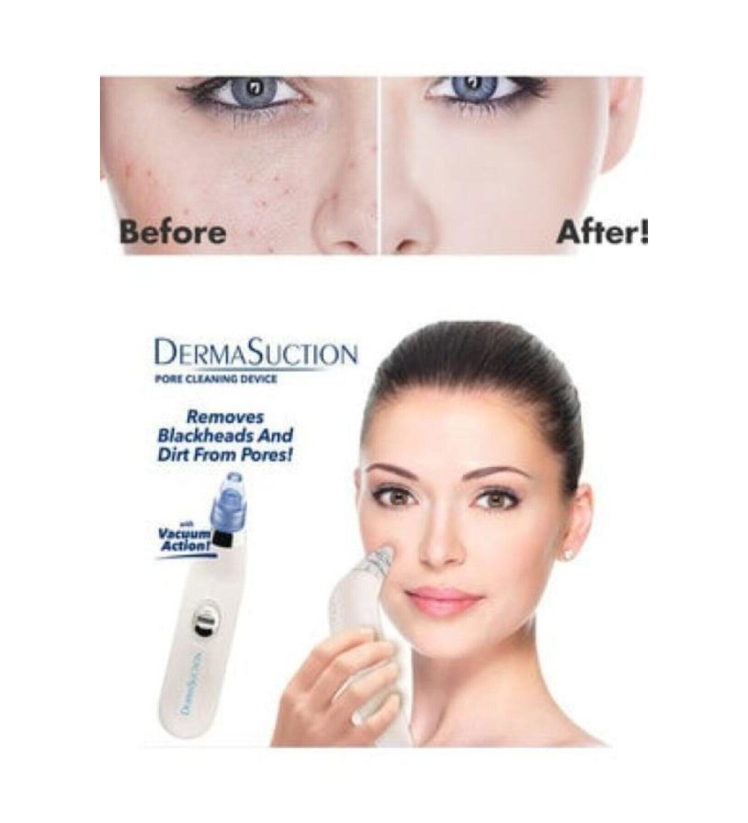 dermasuction Makeup Dermasuction 40kpa Vacuum Blackhead and Acne Removal Device