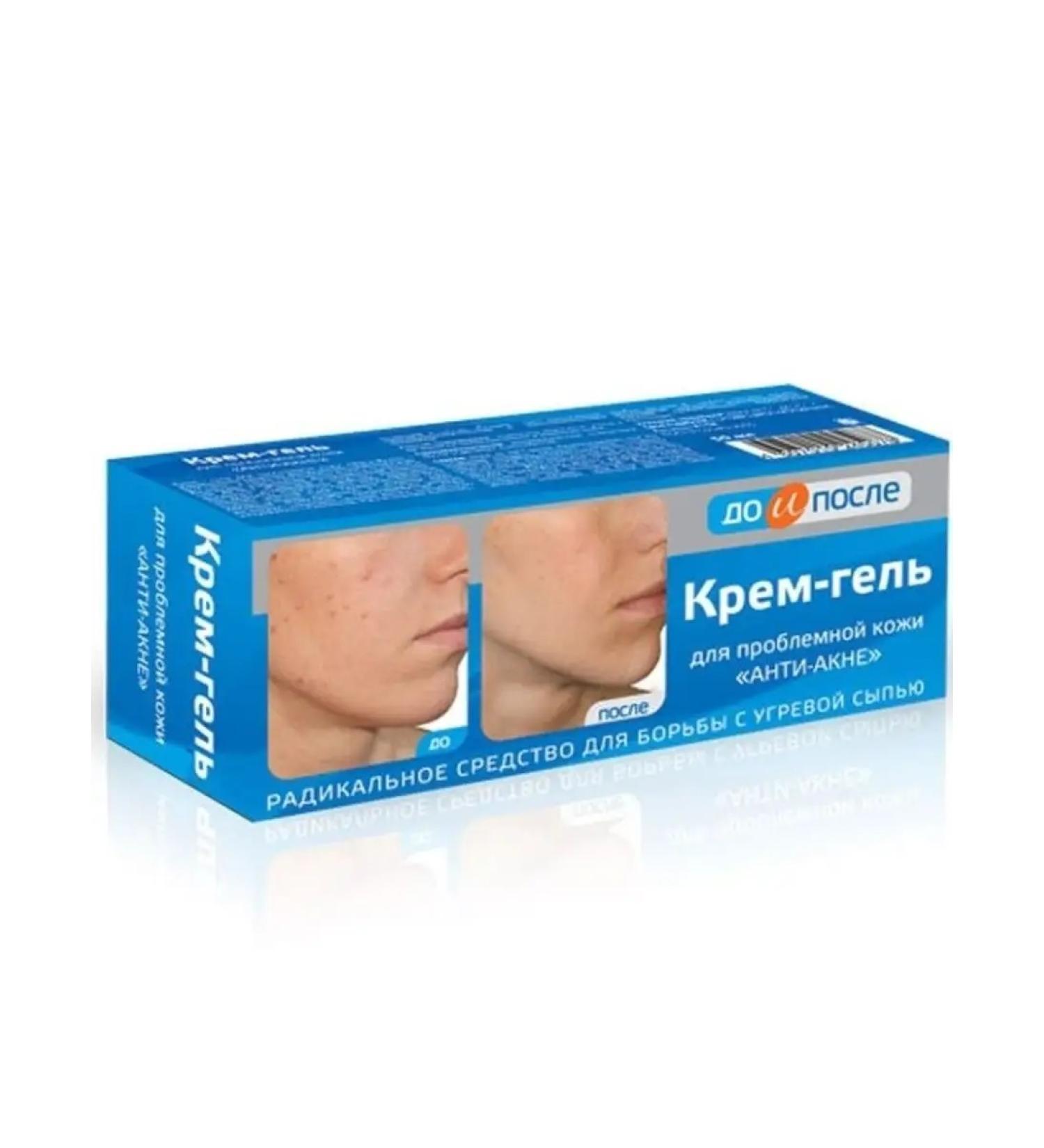 Twins Tech Before and after the anti-acne cream gel for problem skin - Buy Online on GoSupps.com