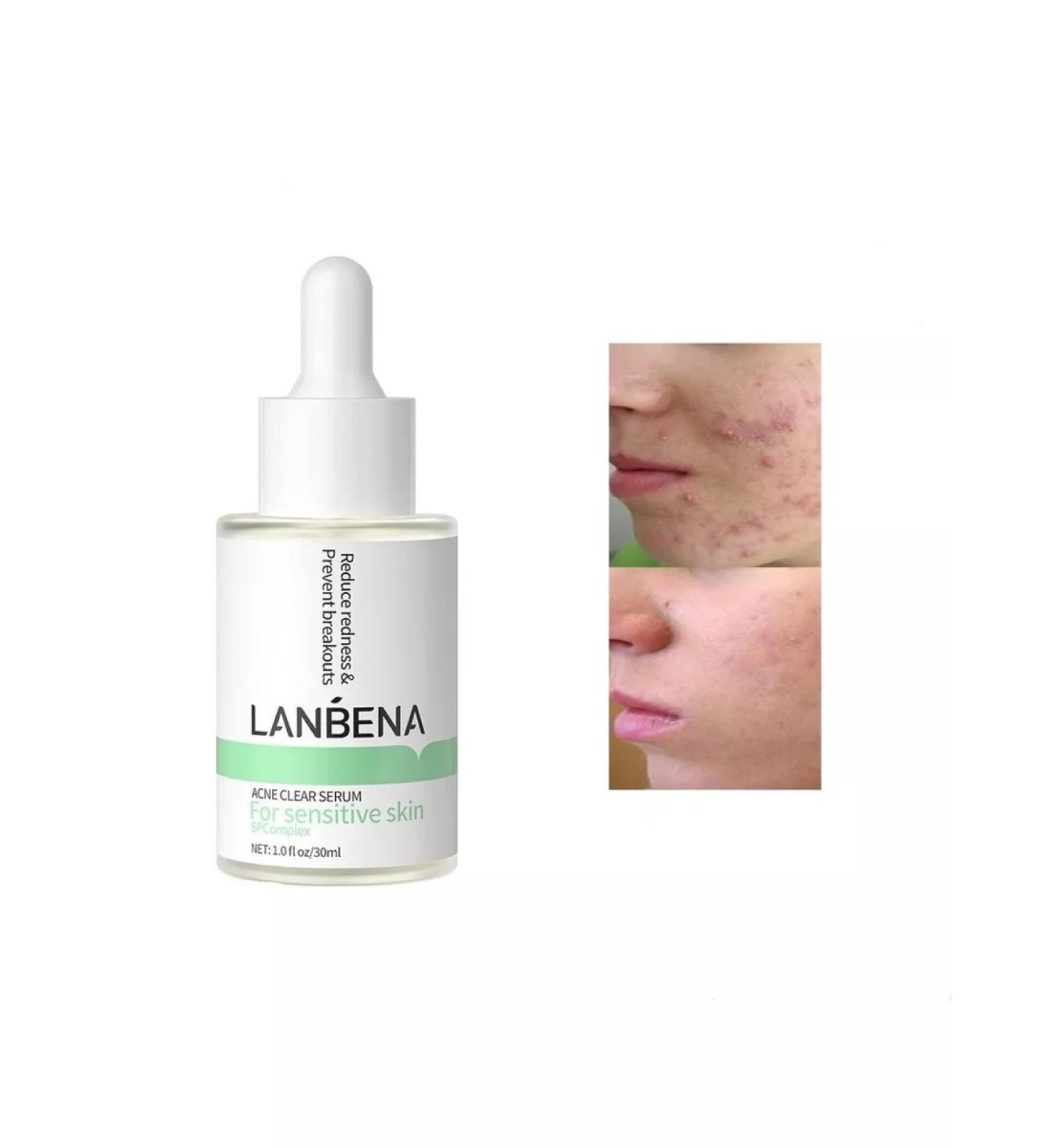 LANBENA From acne whey for sensitive skin 30 ml - Buy Online on GoSupps.com