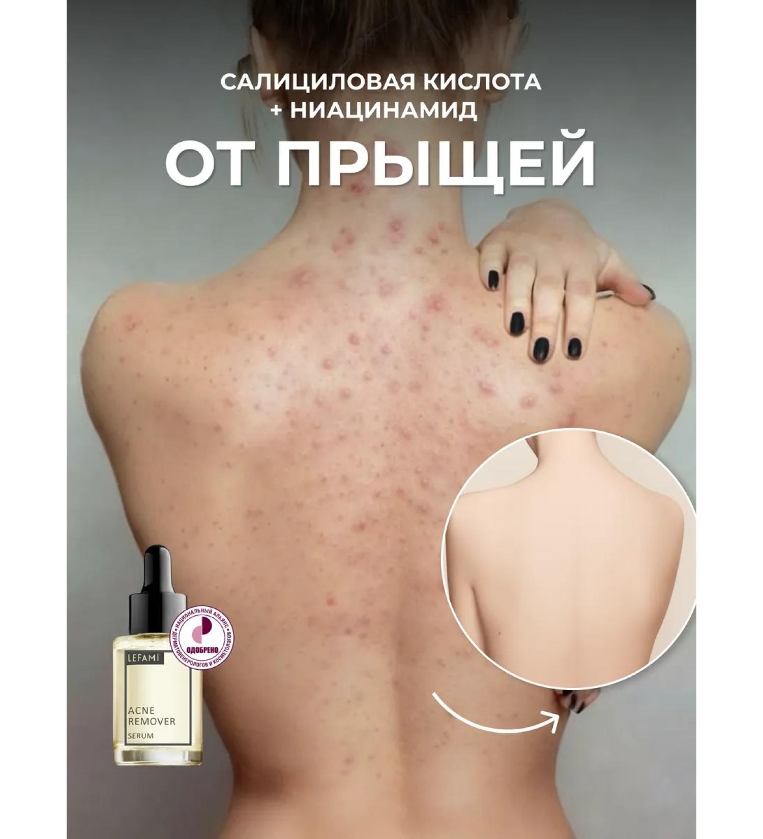 Lefami Acne and acne serum - Buy Online on GoSupps.com