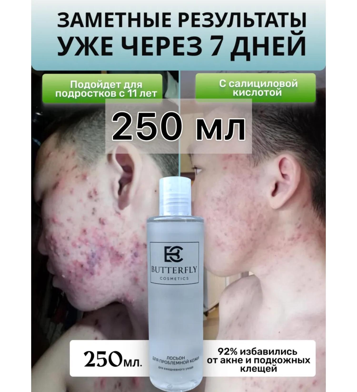 Butterfly Acne and acne lotion on the face and body 250 ml - Buy Online on GoSupps.com