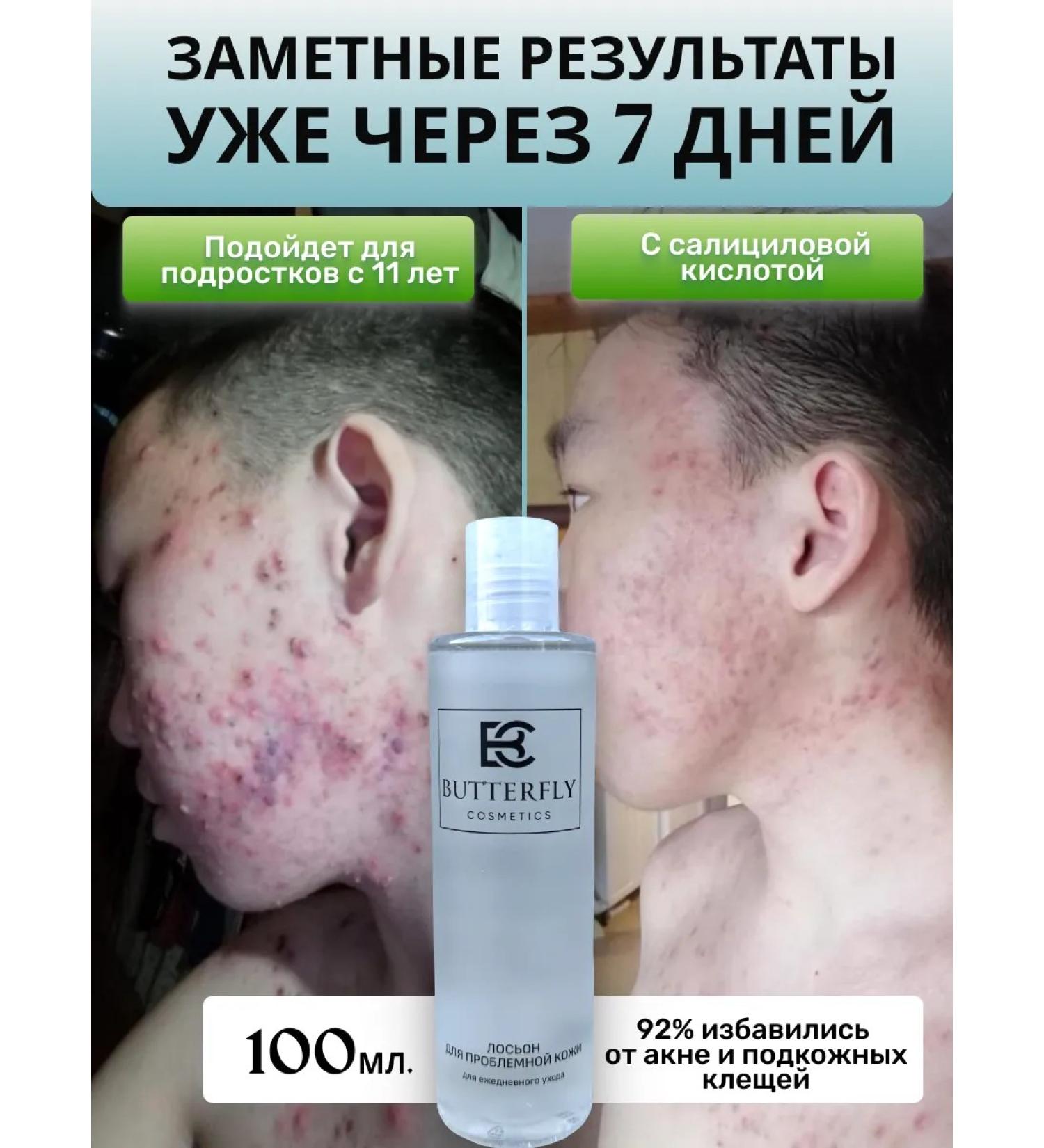 Butterfly Acne and acne lotion on the face and body 100 ml - Buy Online on GoSupps.com