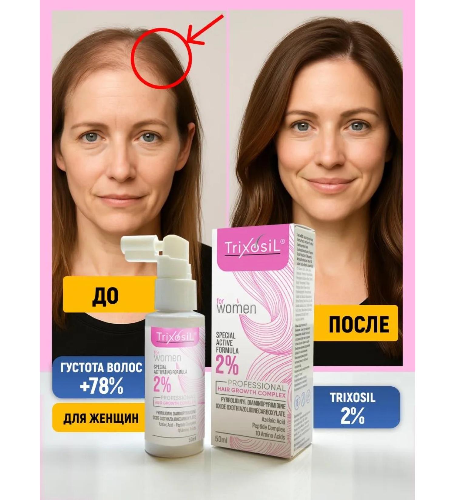 Trixosil Lotion 2% for hair growth against falling out - Buy Online on GoSupps.com