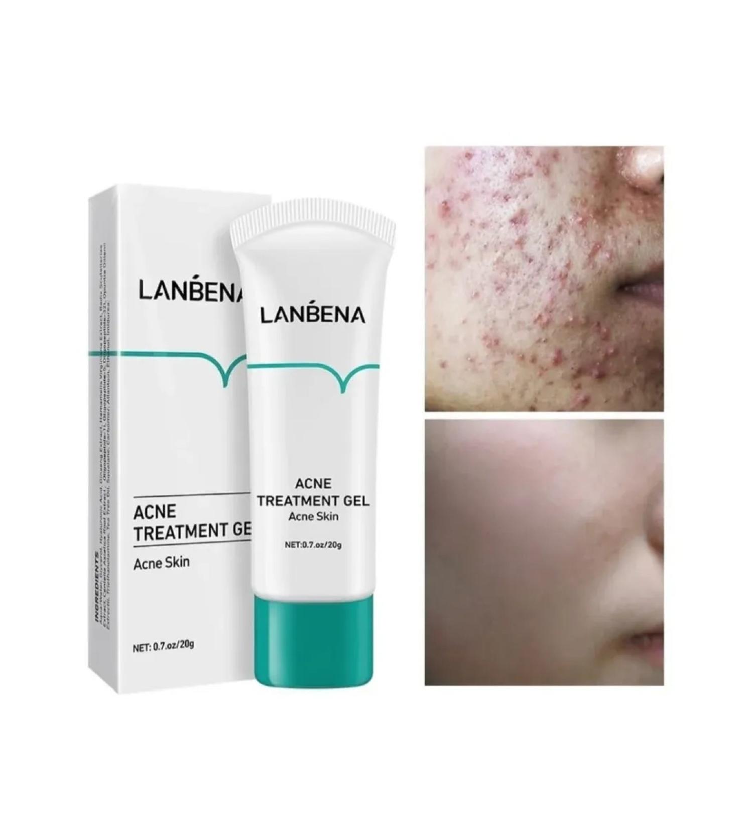 LANBENA From acne acne from rashes
