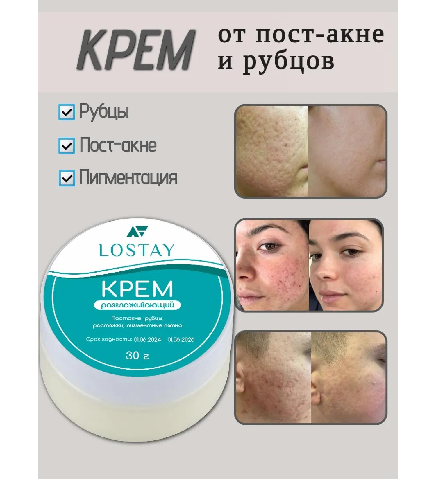 LOSTAY Cream from scars post -acne