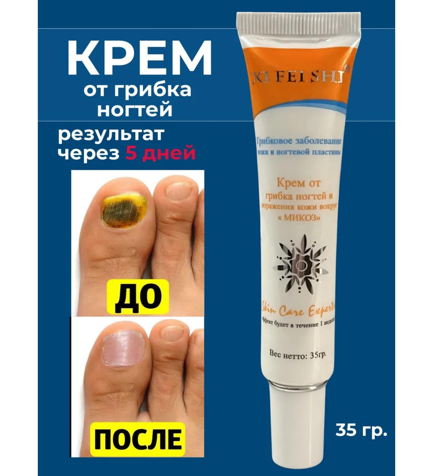 GlobalGoods Cream from nail fungus and skin lesions around - Buy Online on GoSupps.com