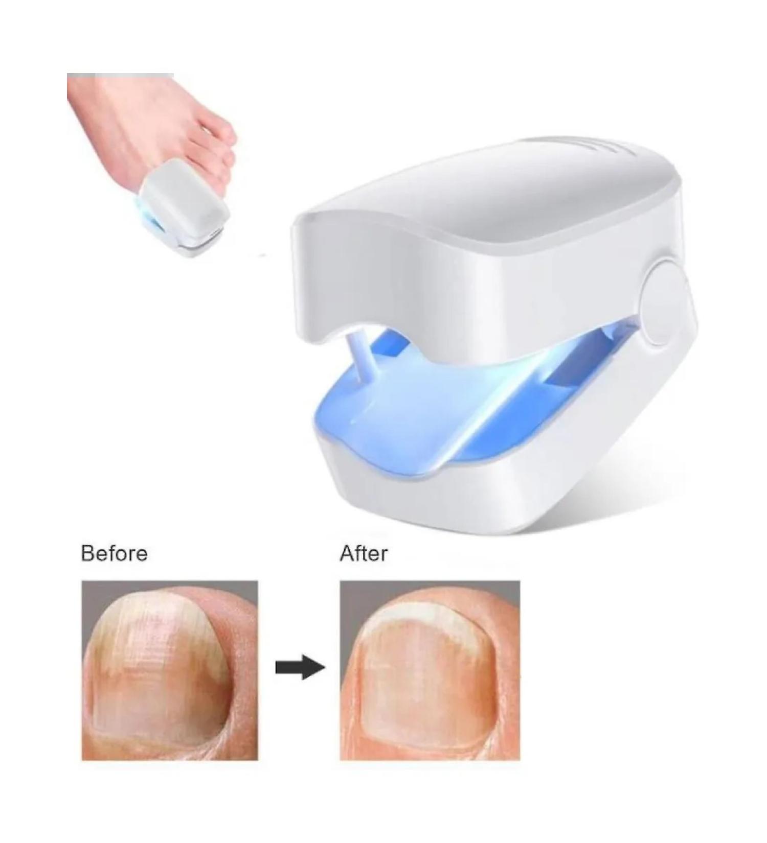 Nail fungus laser therapy device - Buy Online on GoSupps.com