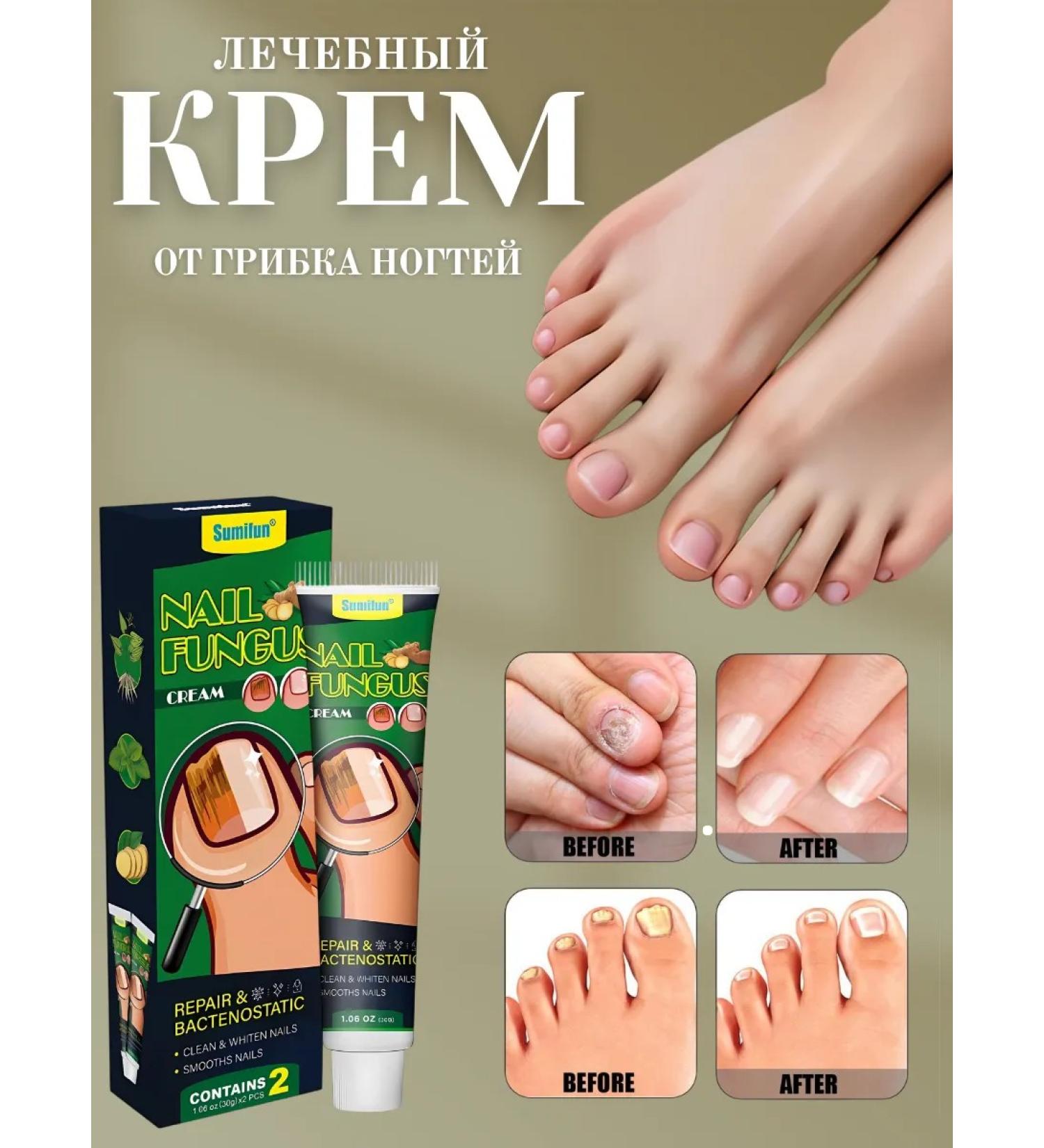 Barynch Remedy for nail fungus on the legs Therapeutic - Buy Online on GoSupps.com