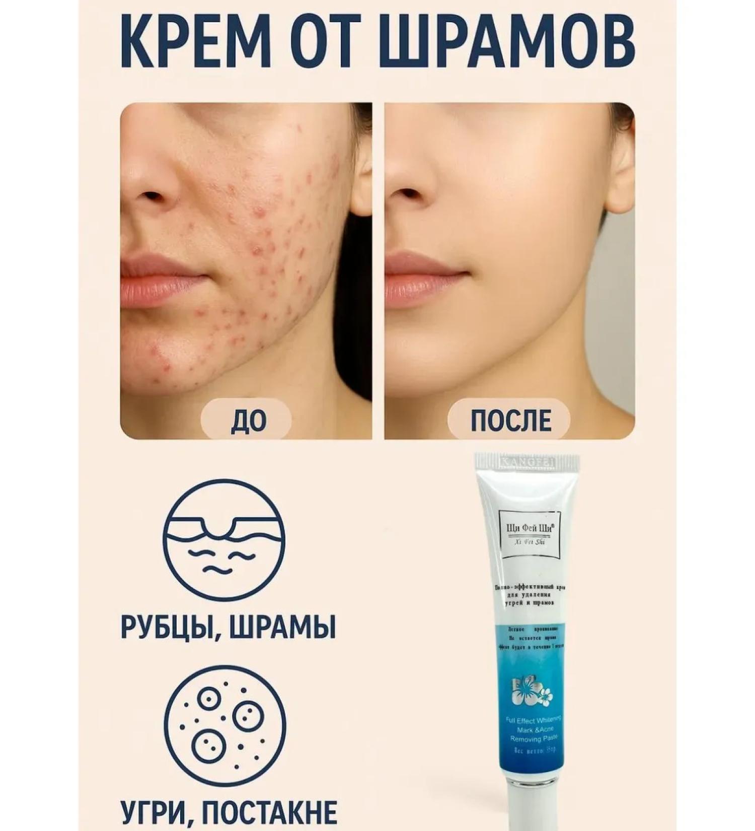 RatiKarS Cream from stretch marks and scars scars and post -acne - Buy Online on GoSupps.com