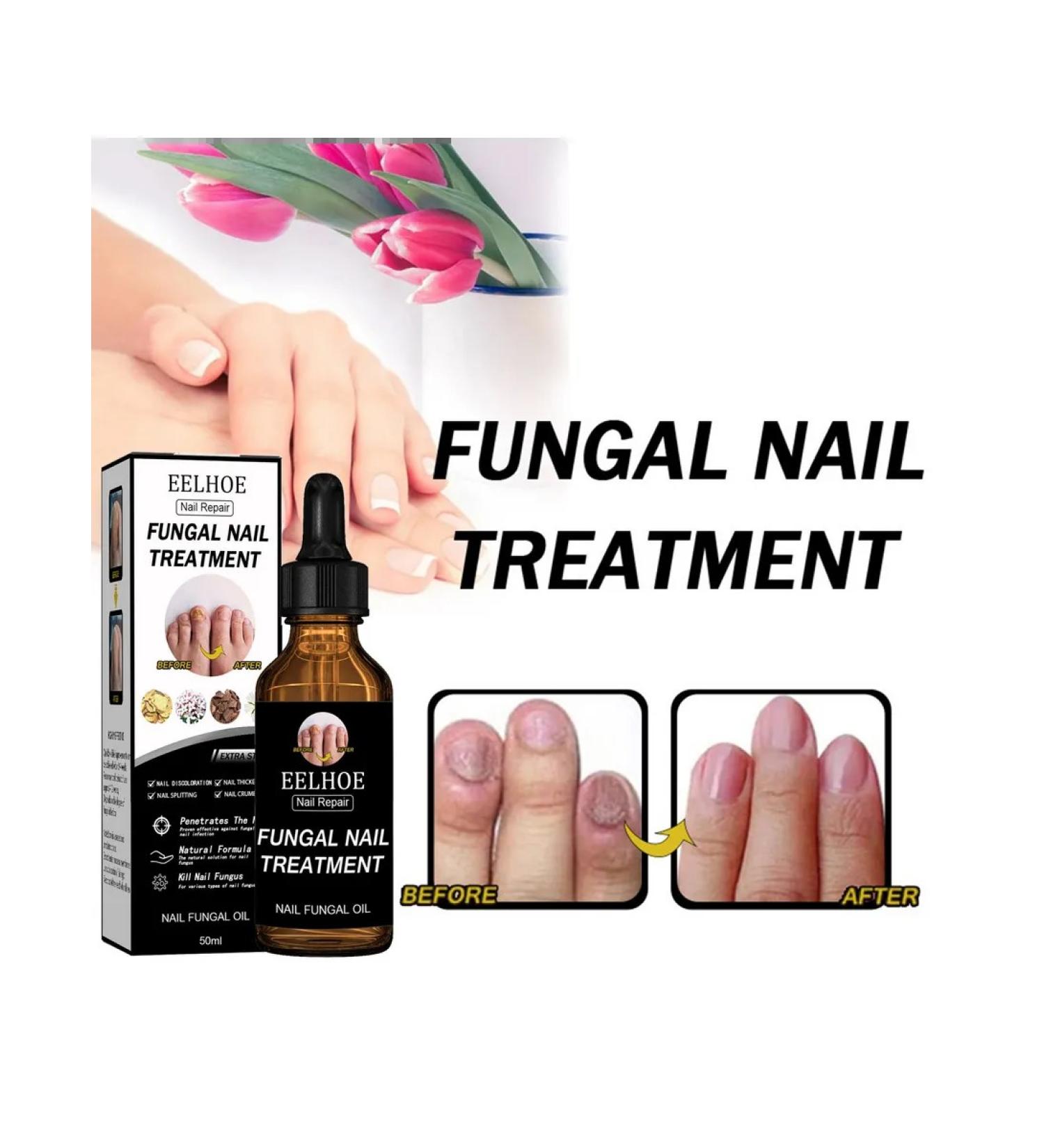 Nail repair solution （30ML） - Buy Online on GoSupps.com