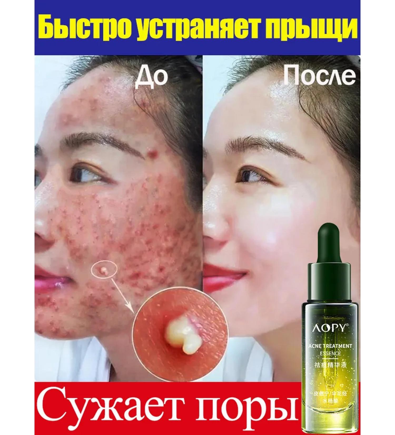 LYDIMOON Facial serum from acne effectively narrows pores 30 ml - Buy Online on GoSupps.com
