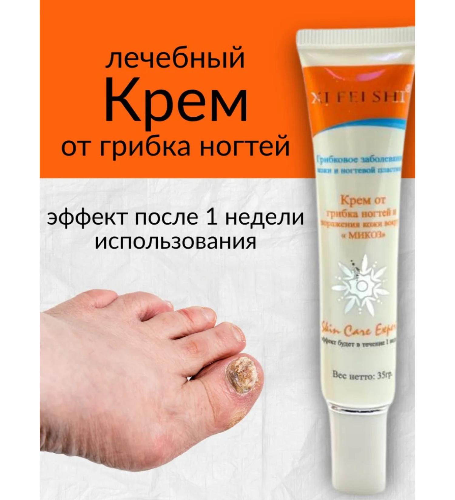 Agaline Effective therapeutic cream from nail fungus and skin lesions - Buy Online on GoSupps.com