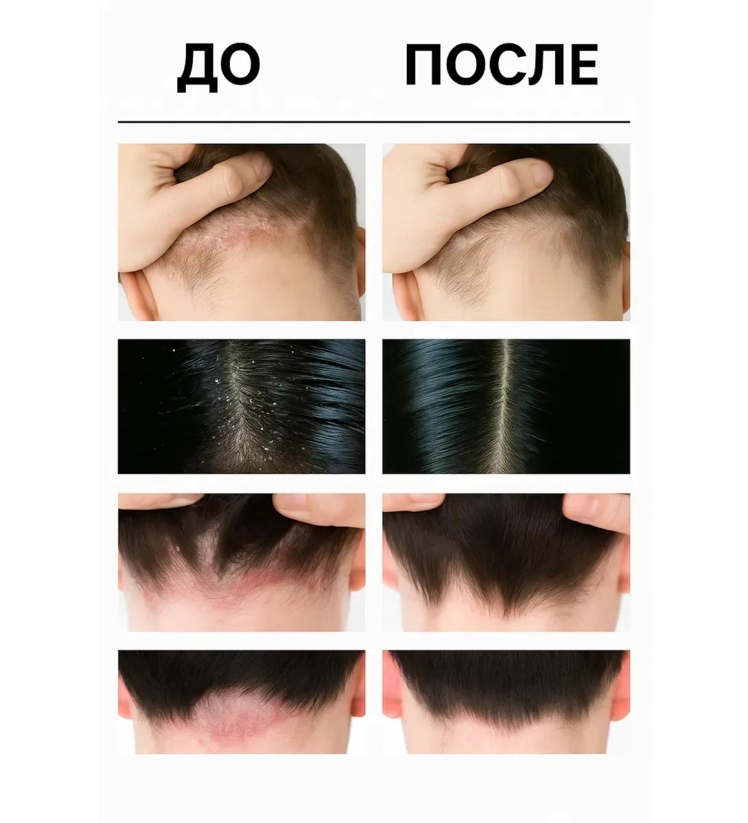 CyberJune Soap against hair loss and seborrhea cream - Buy Online on GoSupps.com