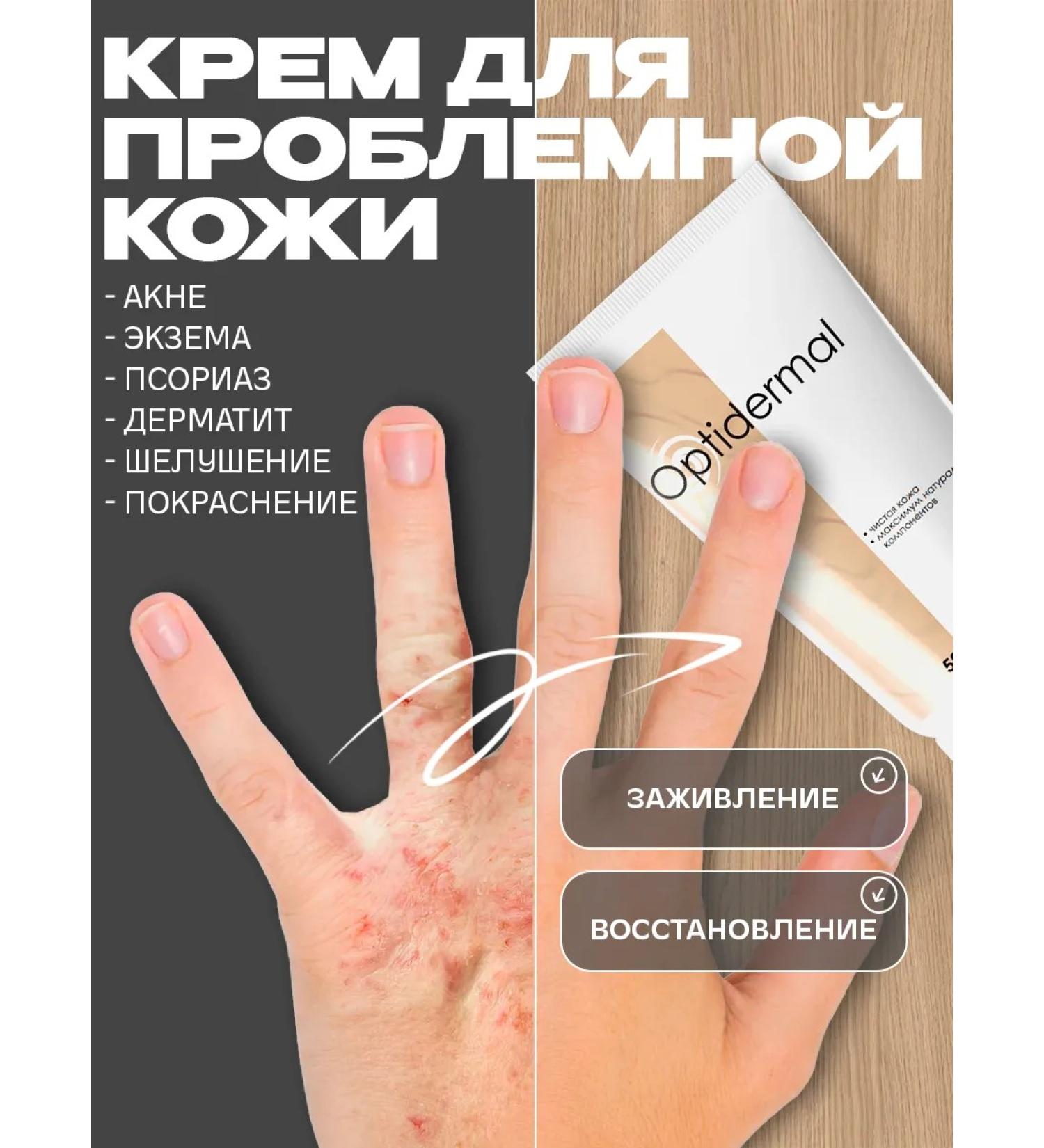 D'umor Ointment from psoriasis from acne and dermatitis - Buy Online on GoSupps.com