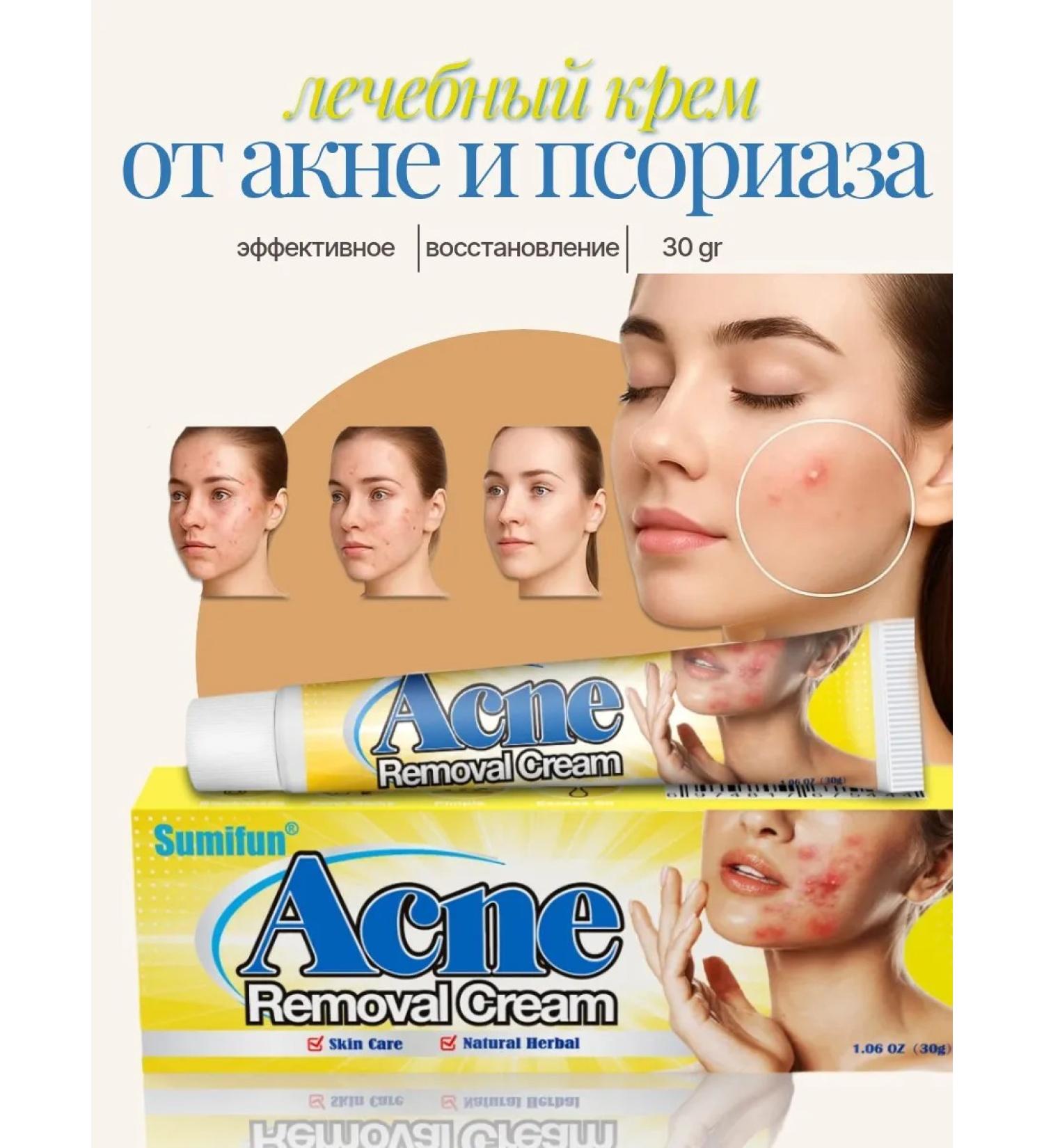 ABR Acne cream for problem skin from acne and acne psoriasis - Buy Online on GoSupps.com