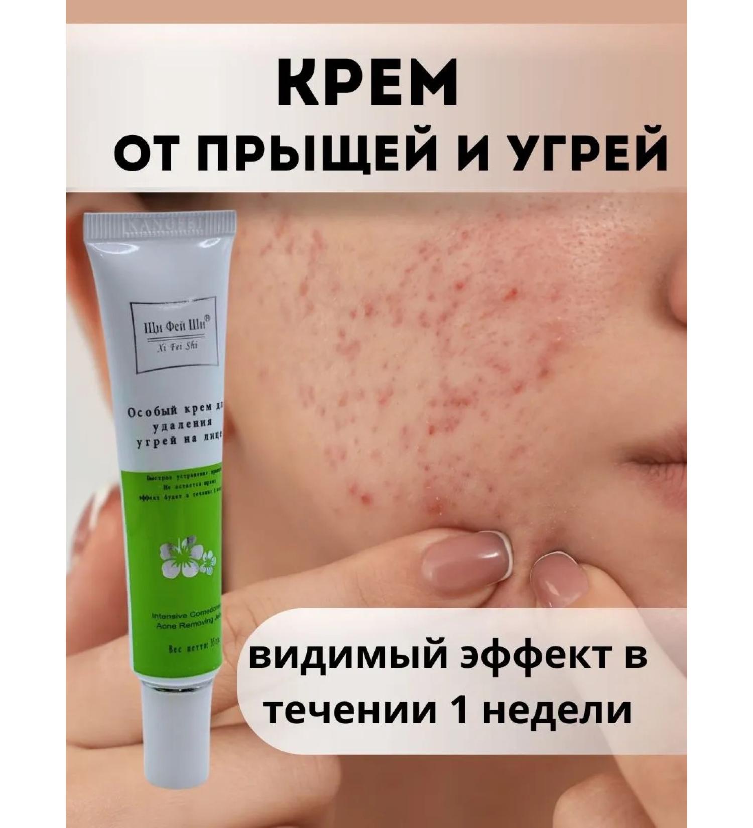 syn Acne cream on the face and acne - Buy Online on GoSupps.com