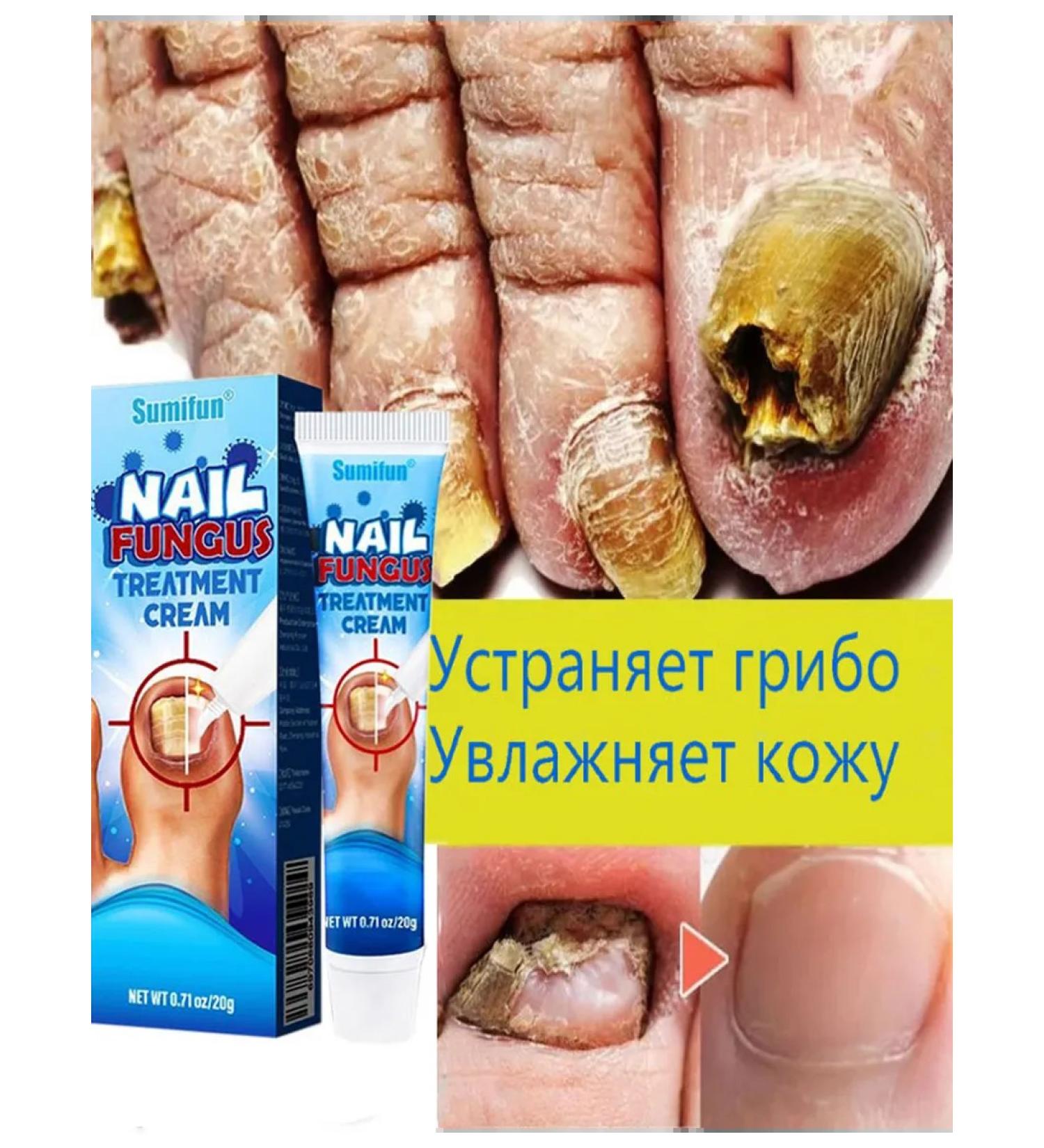 Ointment from nail fungus 20g - Buy Online on GoSupps.com